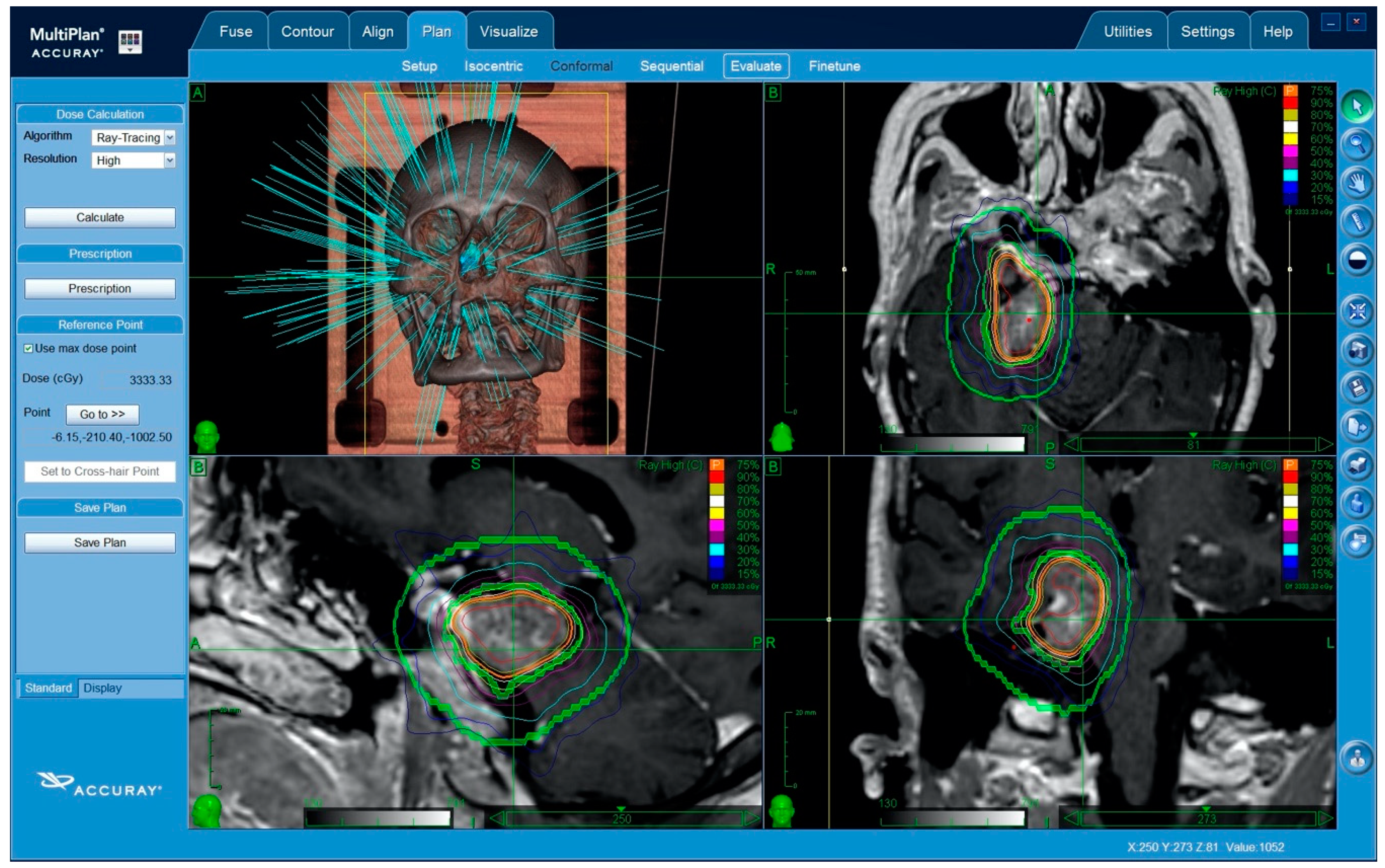 脳神経外科  Skull Base Meningiomas fneur-13-855973-g001.jpg