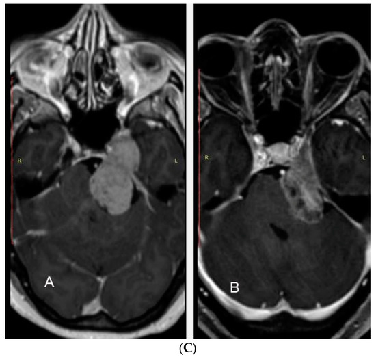 Image-Guided Multisession Radiosurgery of Skull Base Meningiomas