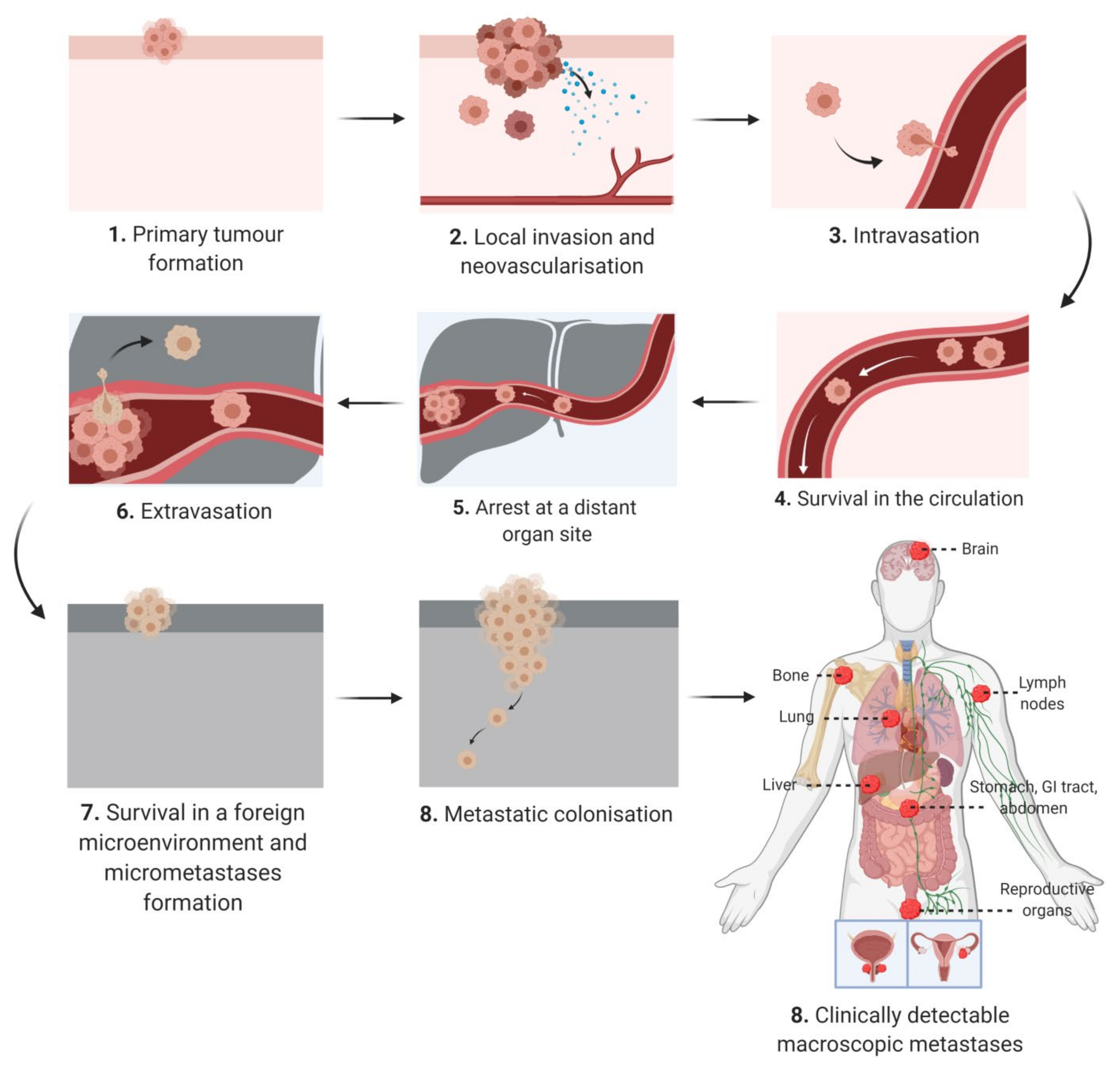 metastatic cancer is