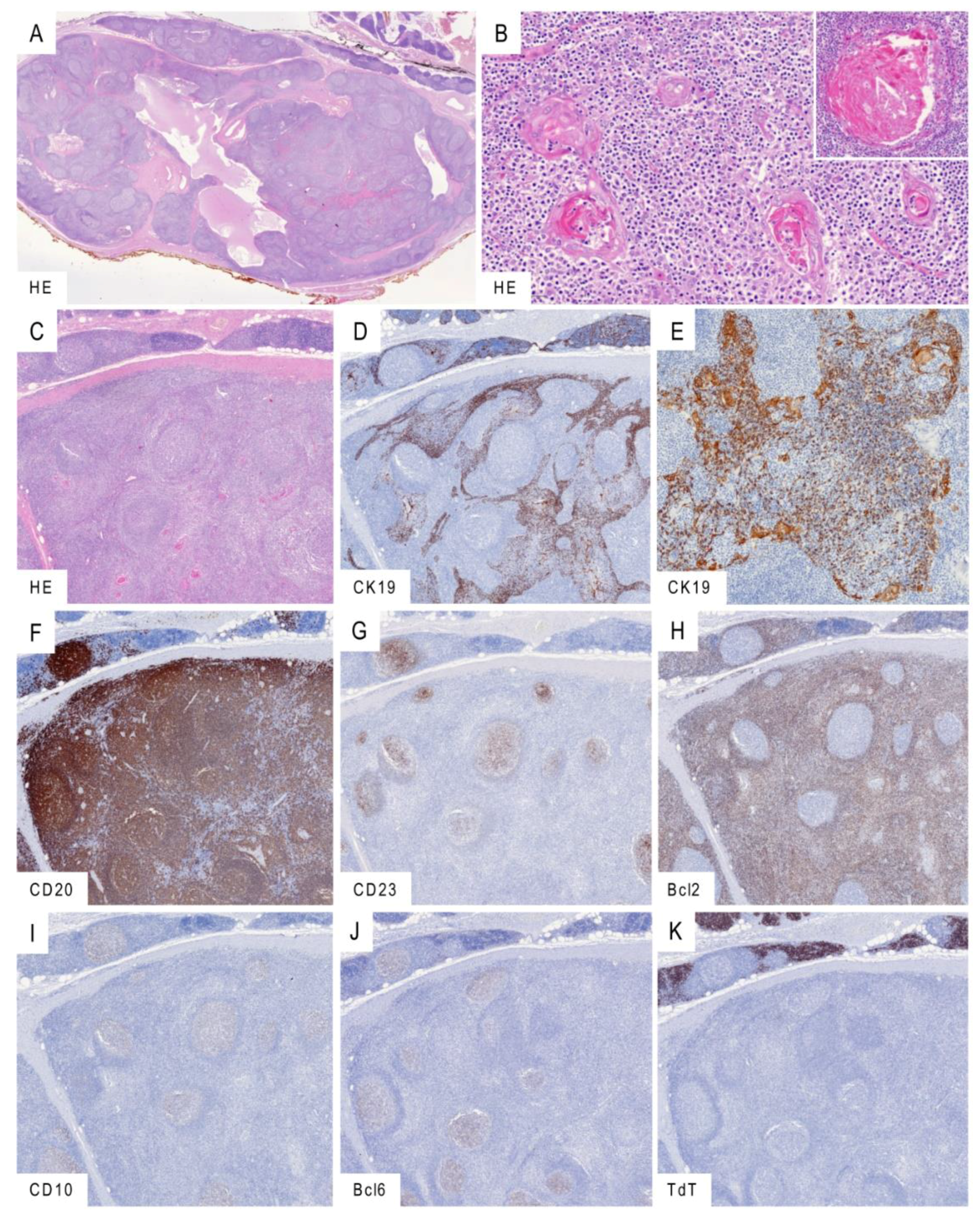 Cancers Free Full Text Thymic Hyperplasia With Lymphoepithelial Sialadenitis Lesa Like Features Strong Association With Lymphomas And Non Myasthenic Autoimmune Diseases