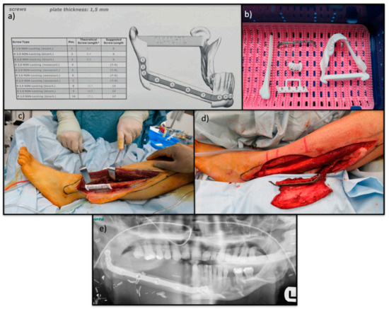 Cancers Free Full Text Surgical Advances In Osteosarcoma