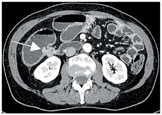 malignant cystic peritoneal mesothelioma