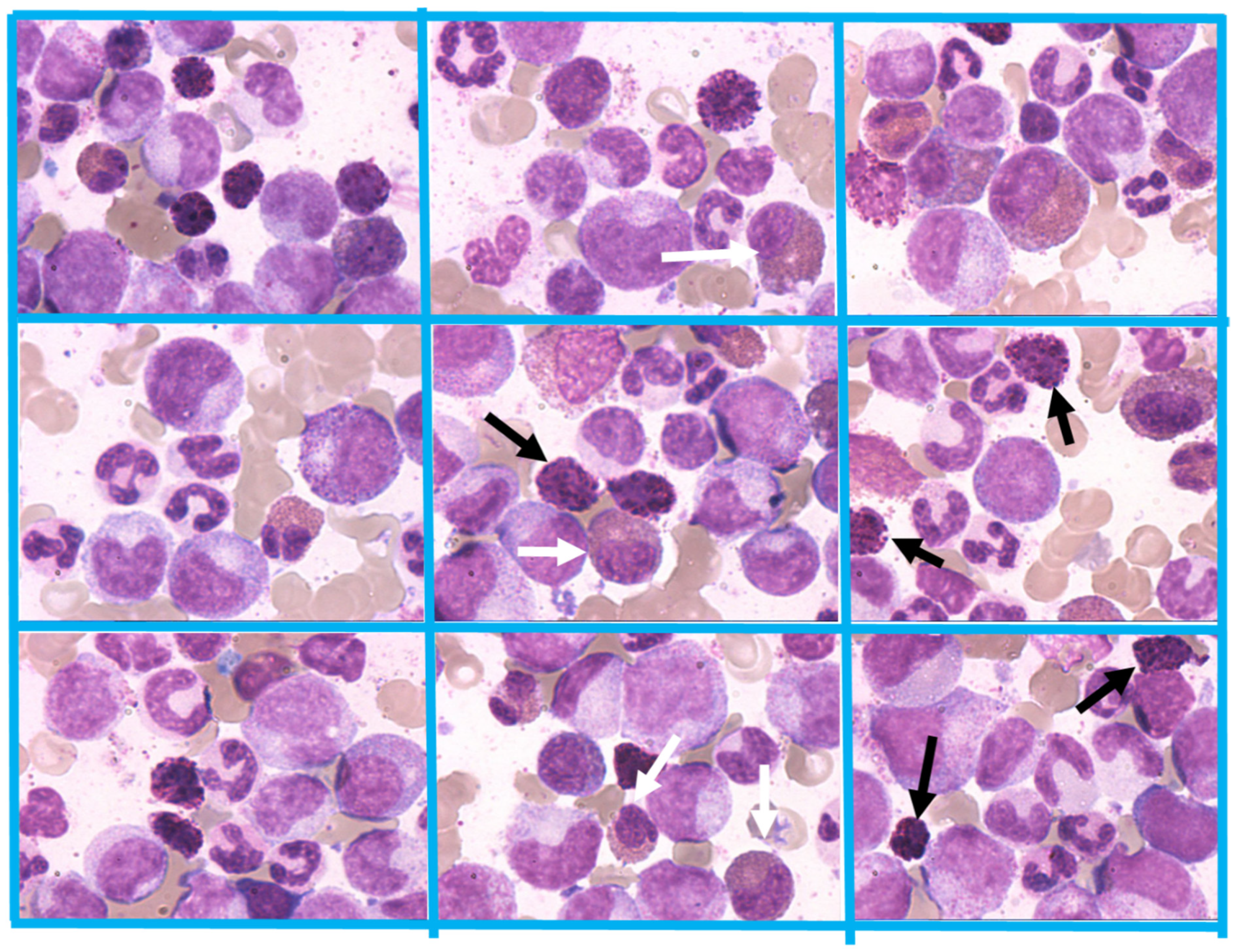 low hematocrit and hemoglobin in cml low hematocrit and hemoglobin in cml