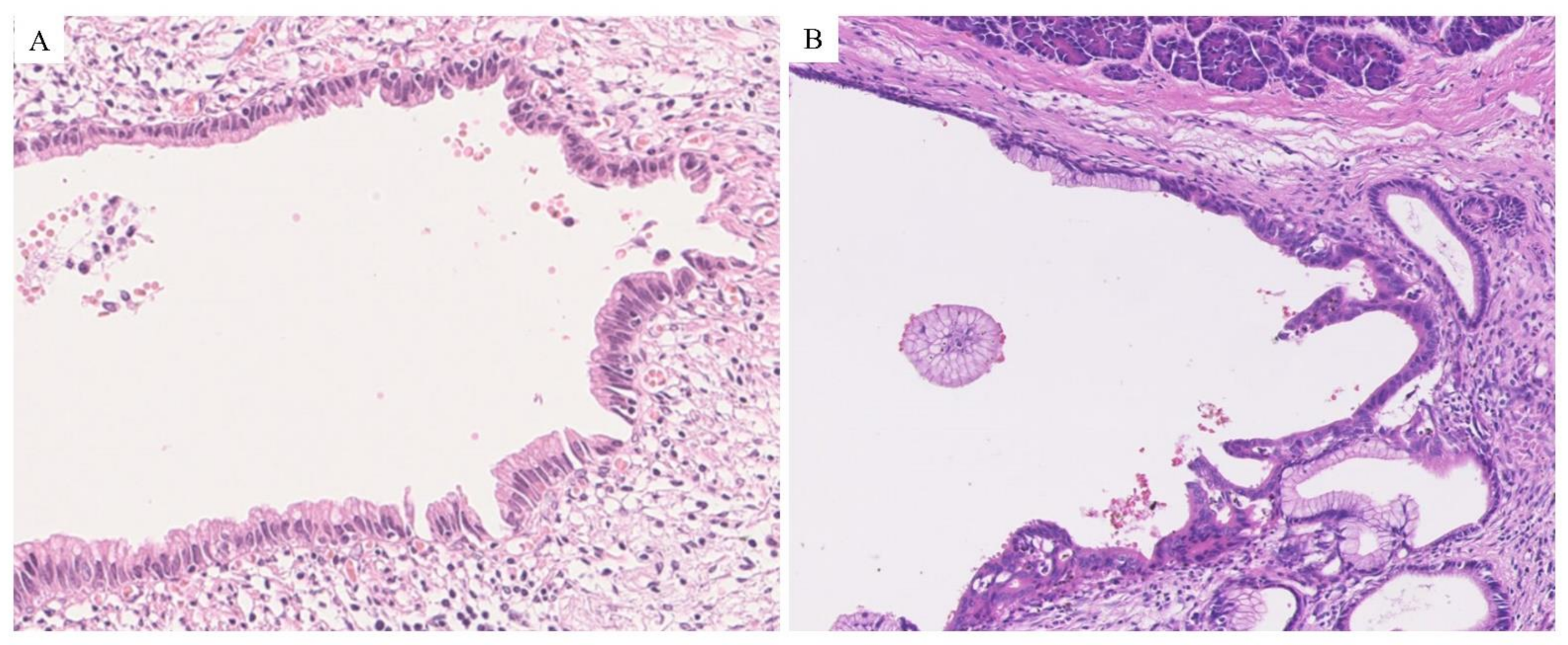 Cancers Free Full Text Pre Operative Imaging And Pathological Diagnosis Of Localized High Grade Pancreatic Intra Epithelial Neoplasia Without Invasive Carcinoma Html Cancers Free Full Text Pre Operative Imaging And Pathological Diagnosis Of Localized High Grade Pancreatic Intra Epithelial Neoplasia Without Invasive Carcinoma Html