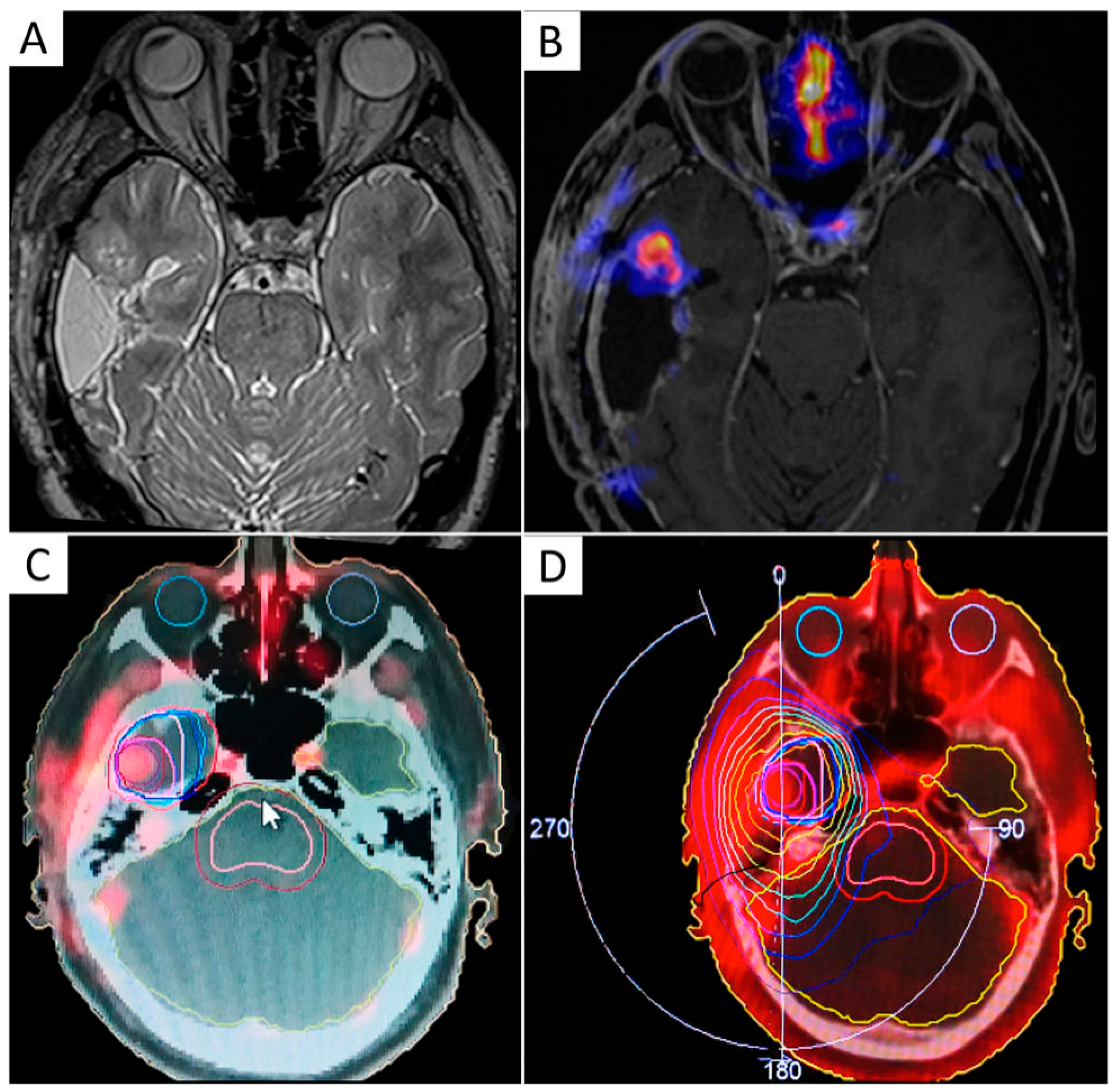 volumetrix example mri volumetrix example mri