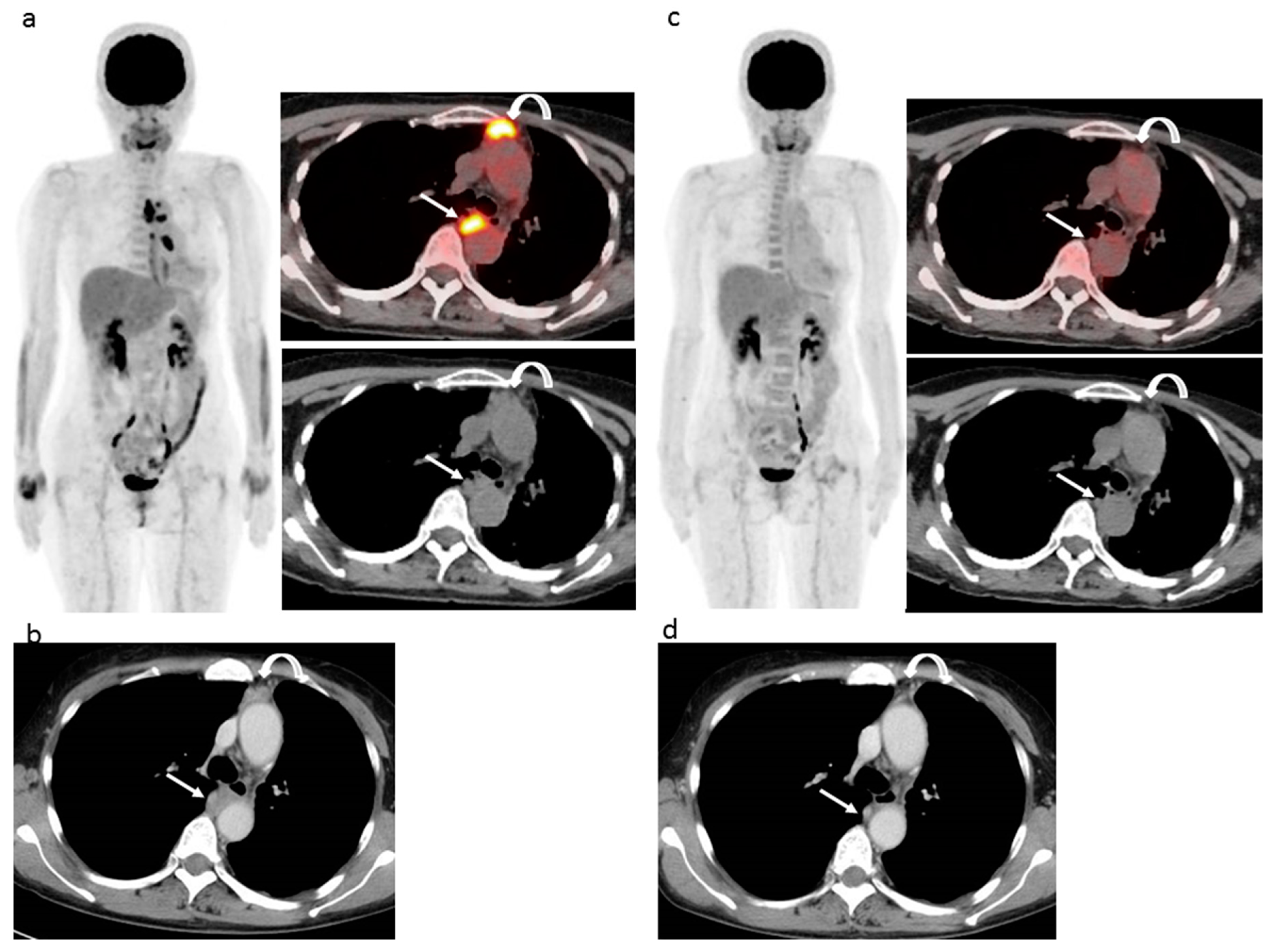 how to test for abdominal ascites