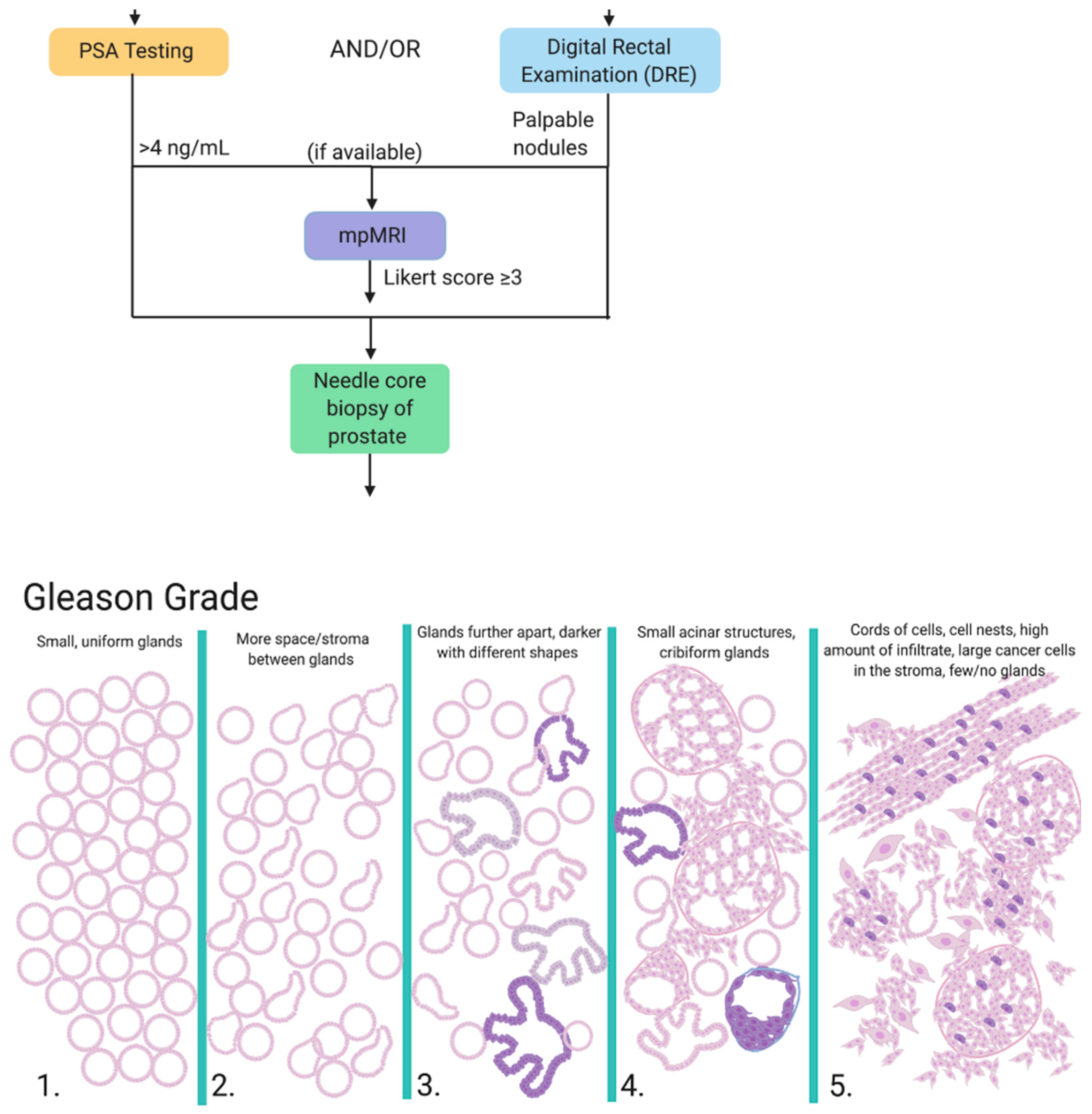 forum cancer prostate gleason 43)