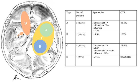 Surgical Outcome of Trigeminal Schwannomas
