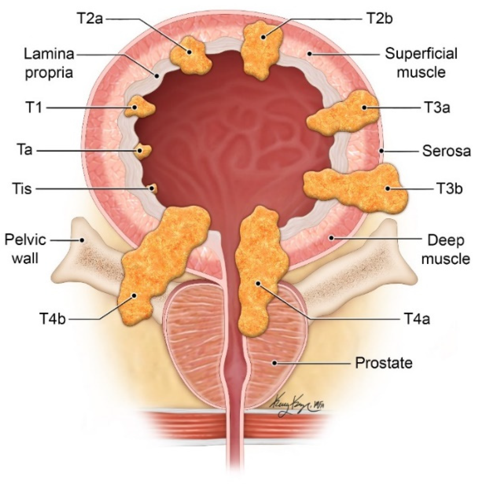 bladder cancer prostate involvement