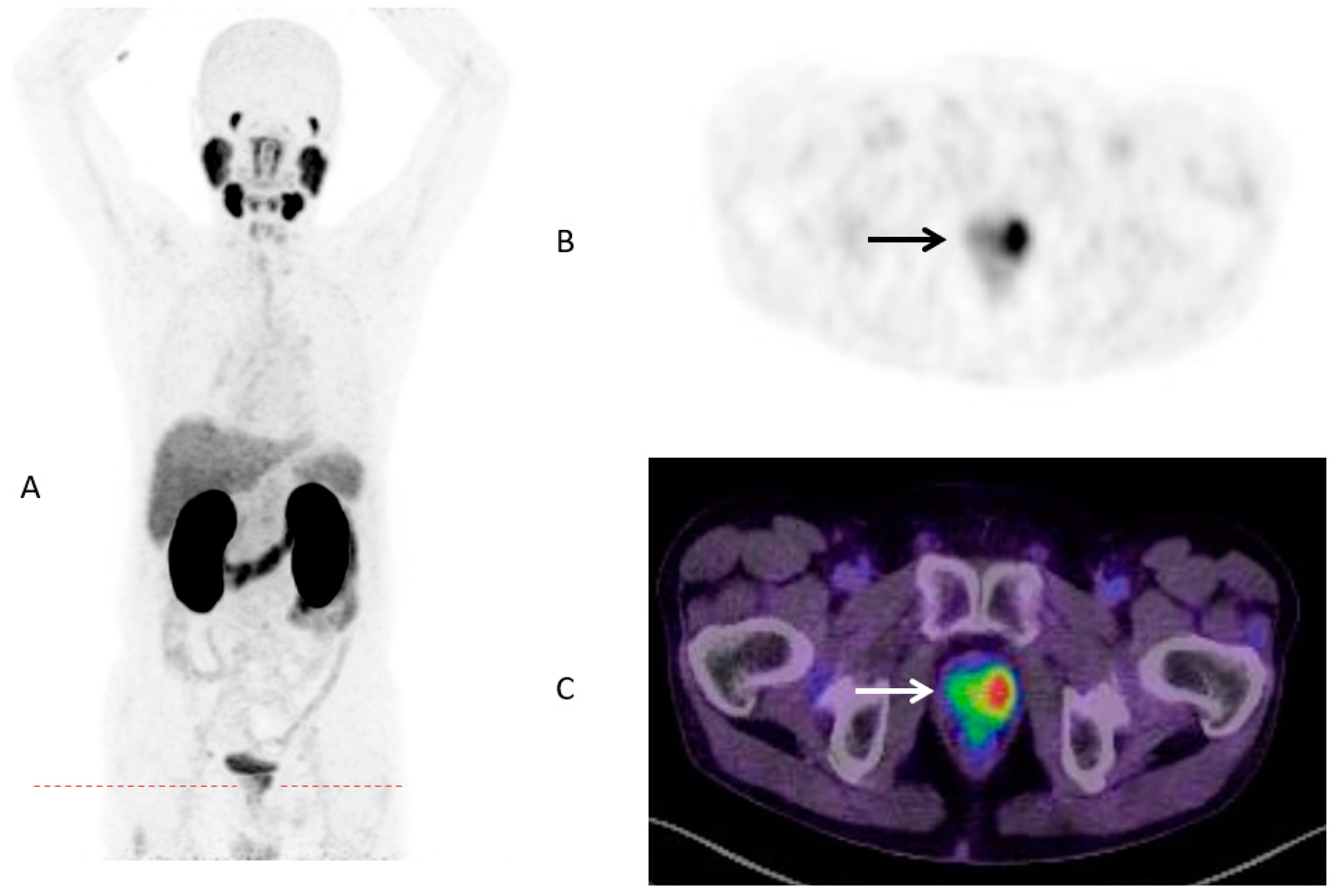 cancer prostate metastase os forum