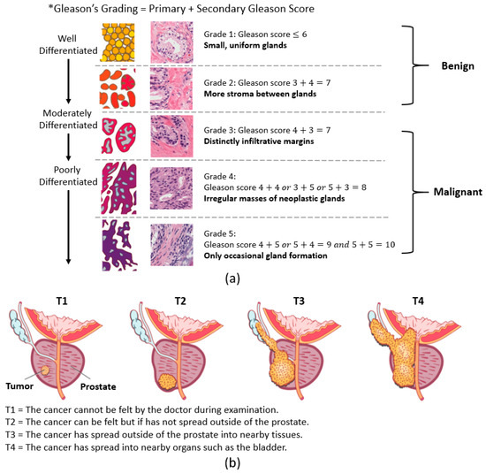 prostate adenocarcinoma gleason score 8