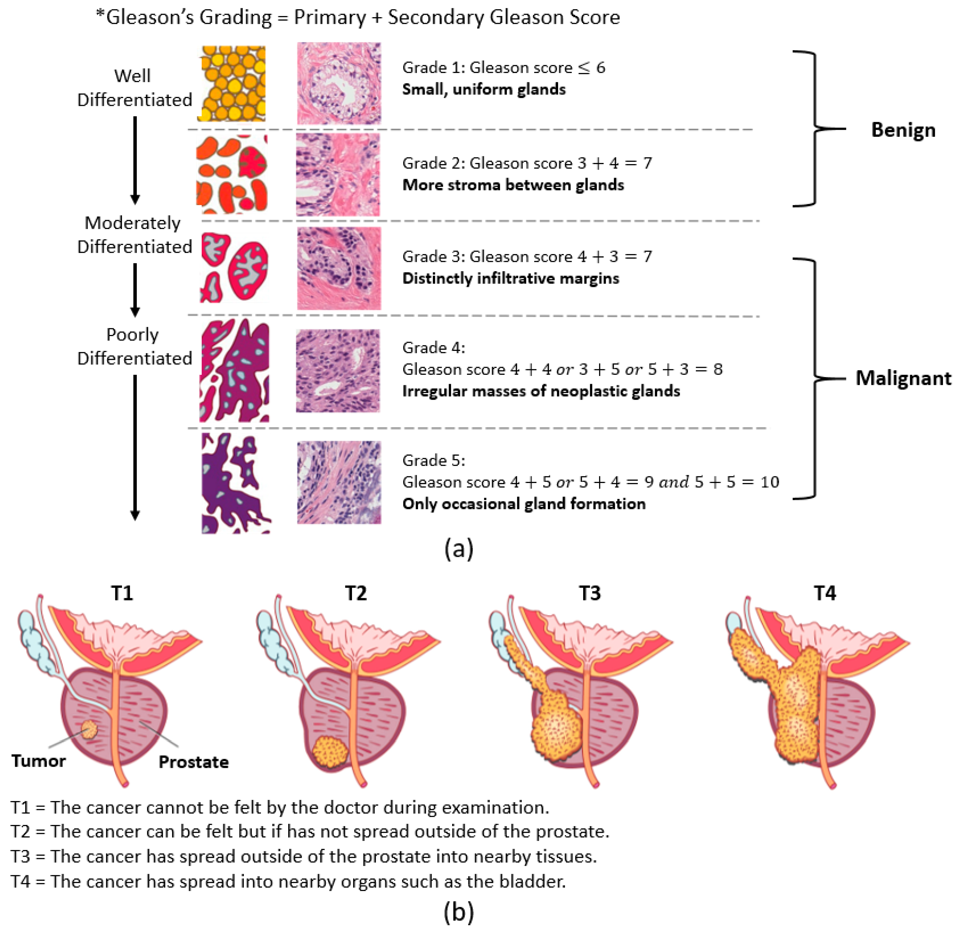 prostate adenocarcinoma gleason score 44= 8