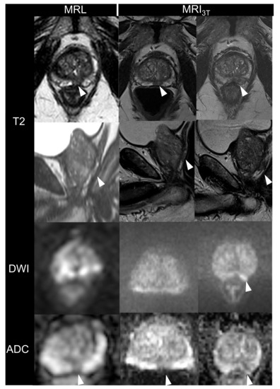 Prospective Image Quality and Lesion Assessment in the Setting of MR ...