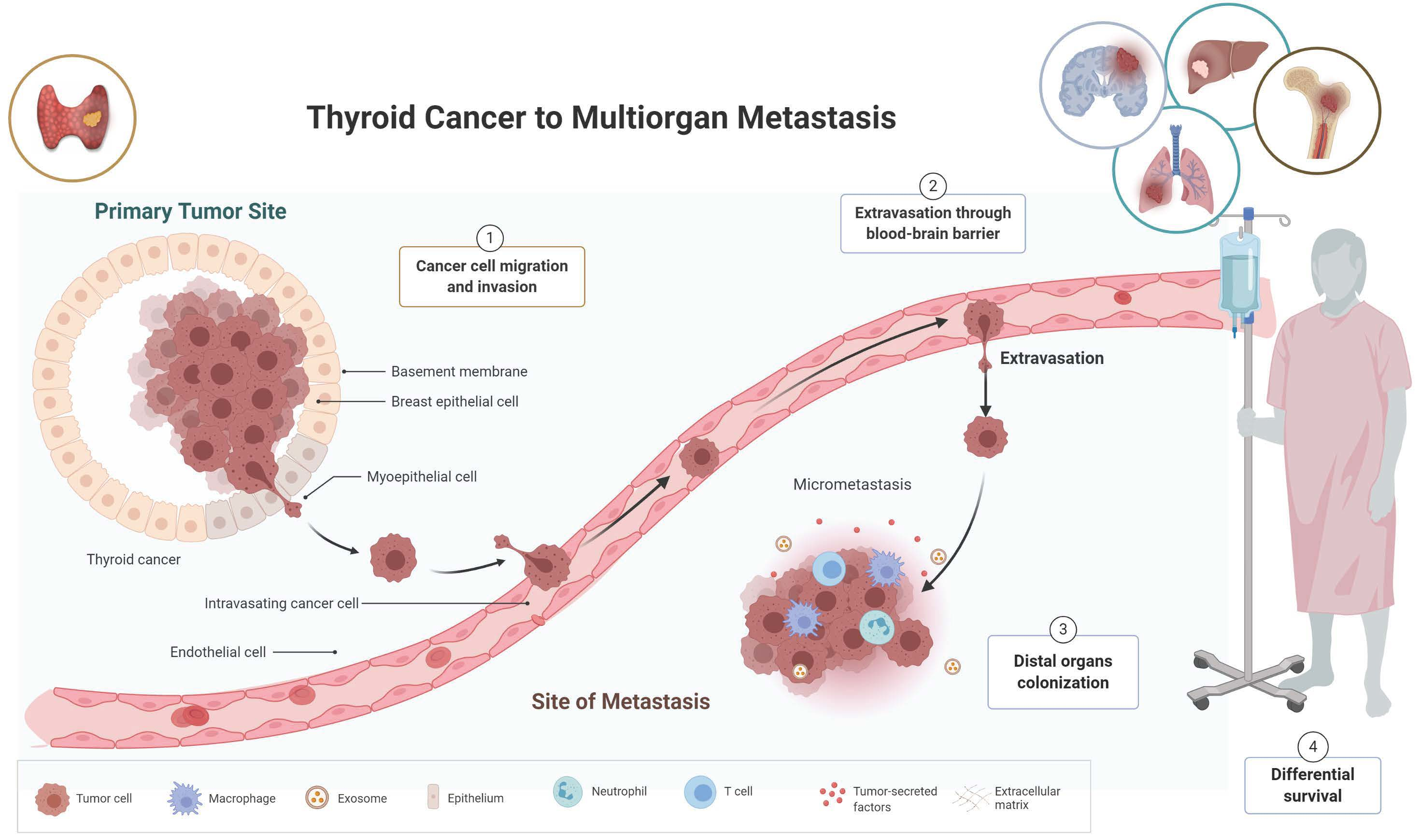 Cancers Free FullText SiteSpecific Metastasis and Survival in