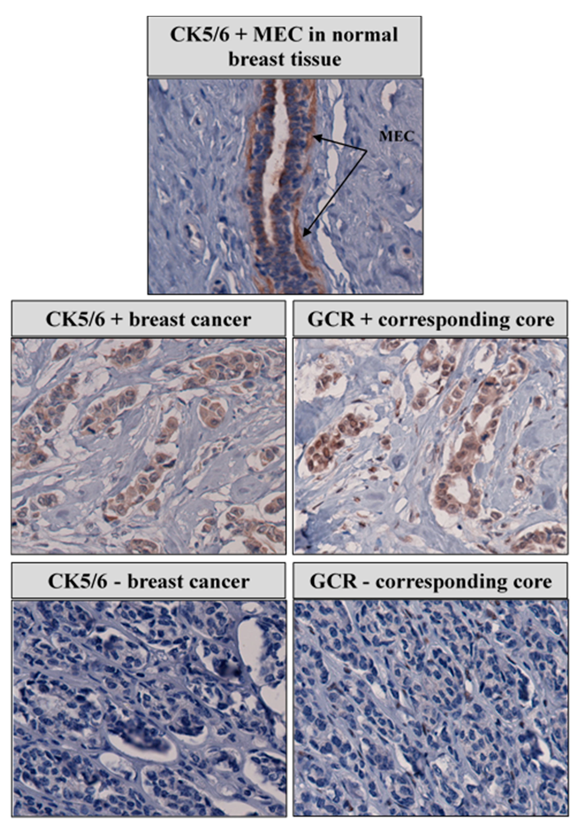 Cancers Free Full Text Genetic Variation And Immunohistochemical Localization Of The Glucocorticoid Receptor In Breast Cancer Cases From The Breast Cancer Care In Chicago Cohort Html Cancers Free Full Text Genetic Variation And Immunohistochemical Localization Of The Glucocorticoid Receptor In Breast Cancer Cases From The Breast Cancer Care In Chicago Cohort Html
