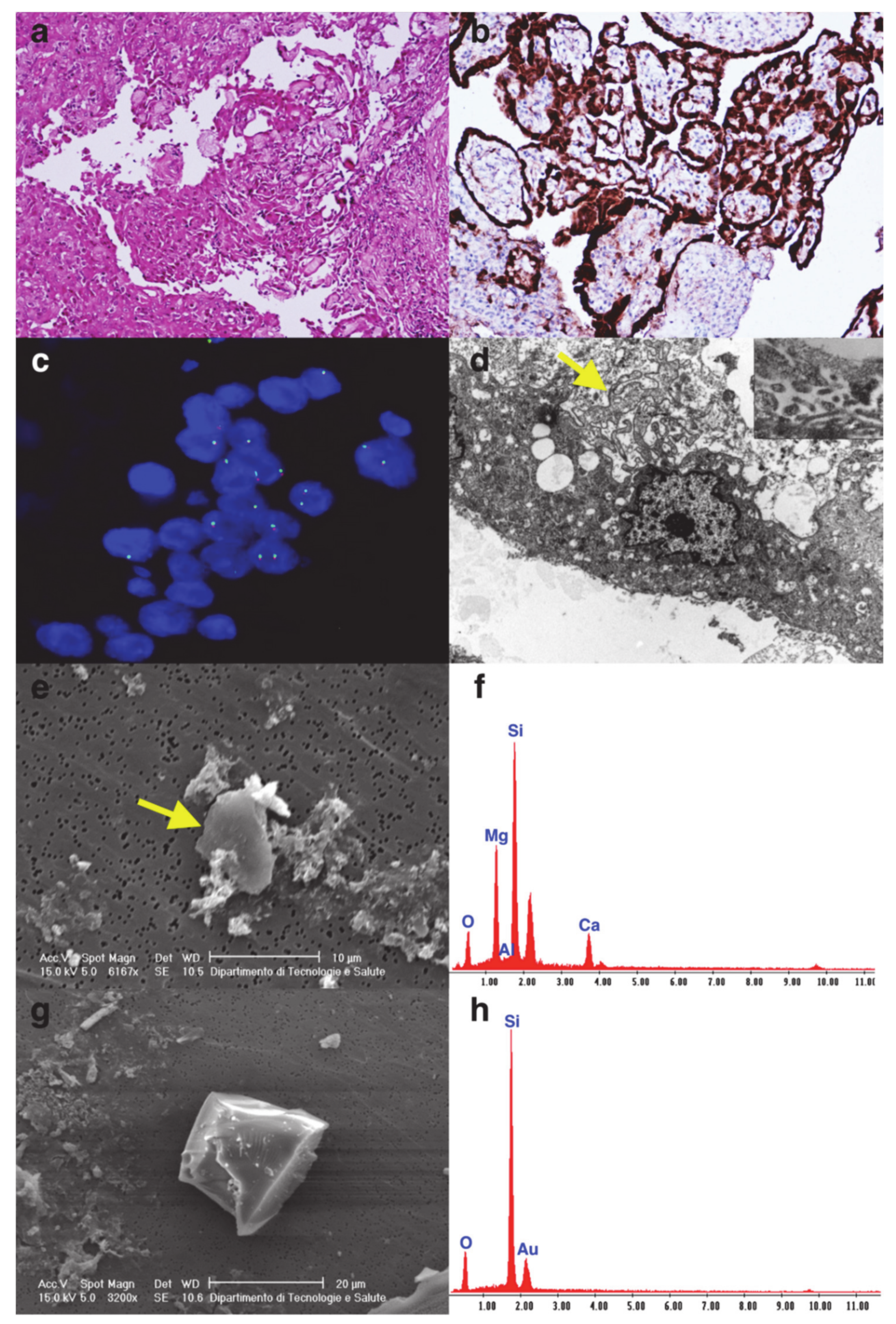 malignant pleural effusion icd 10 code