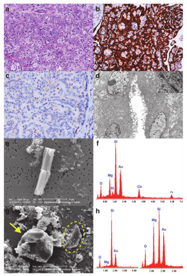 epithelial cell mesothelioma