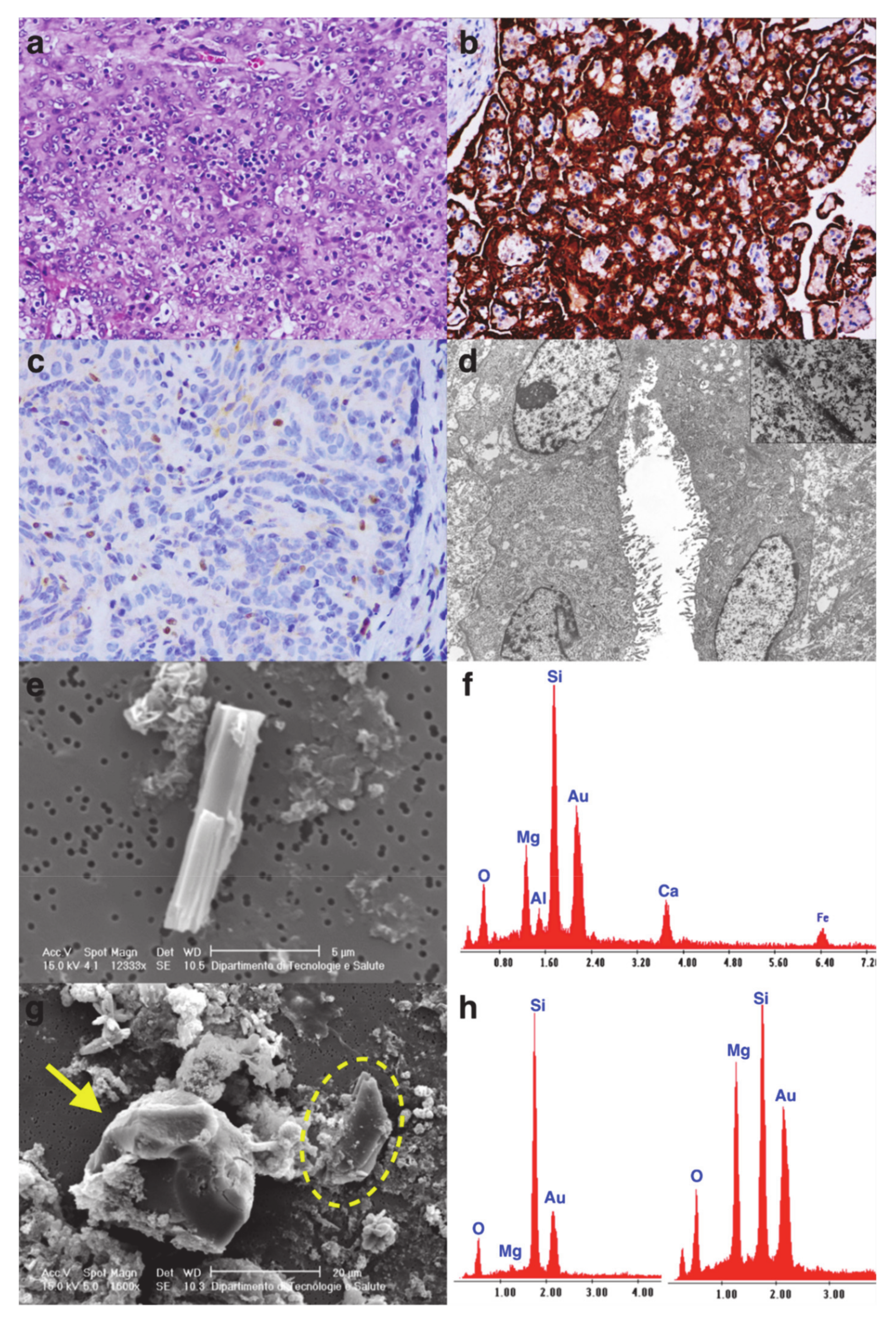 does copd cause fibrosis of the bronchial wall