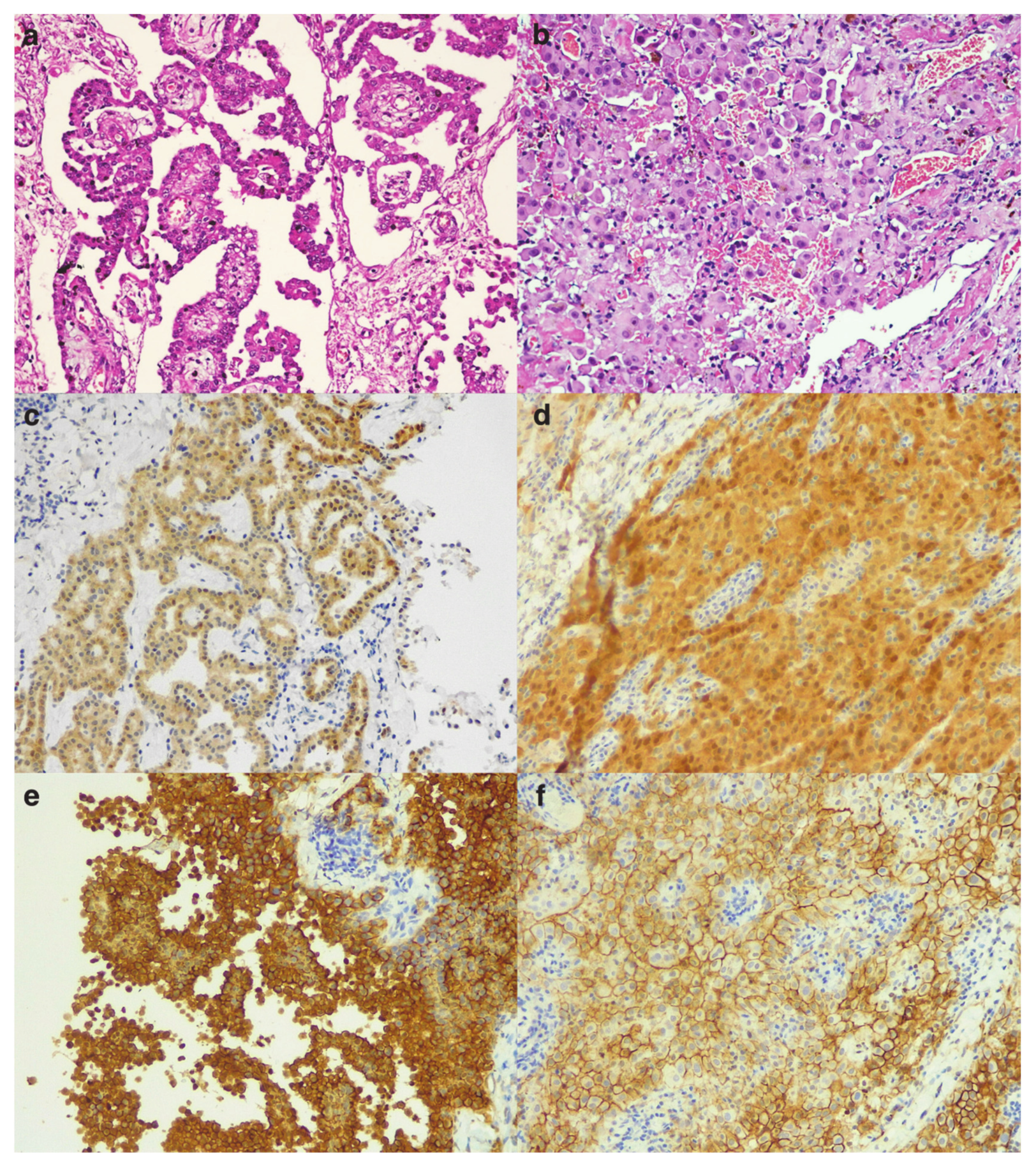 screening for malignant pleural mesothelioma