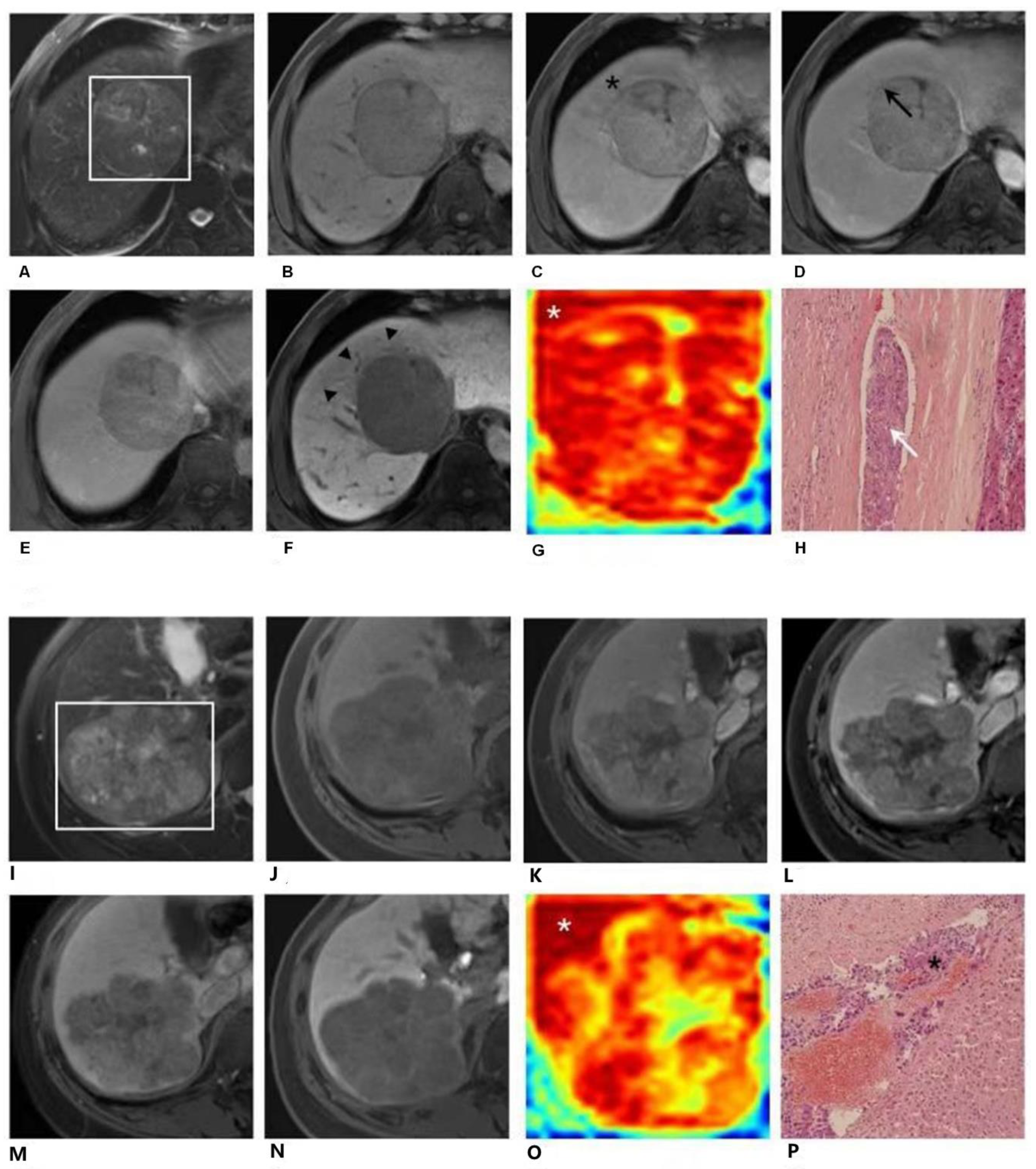 Prediction of Microvascular Invasion in Hepatocellular