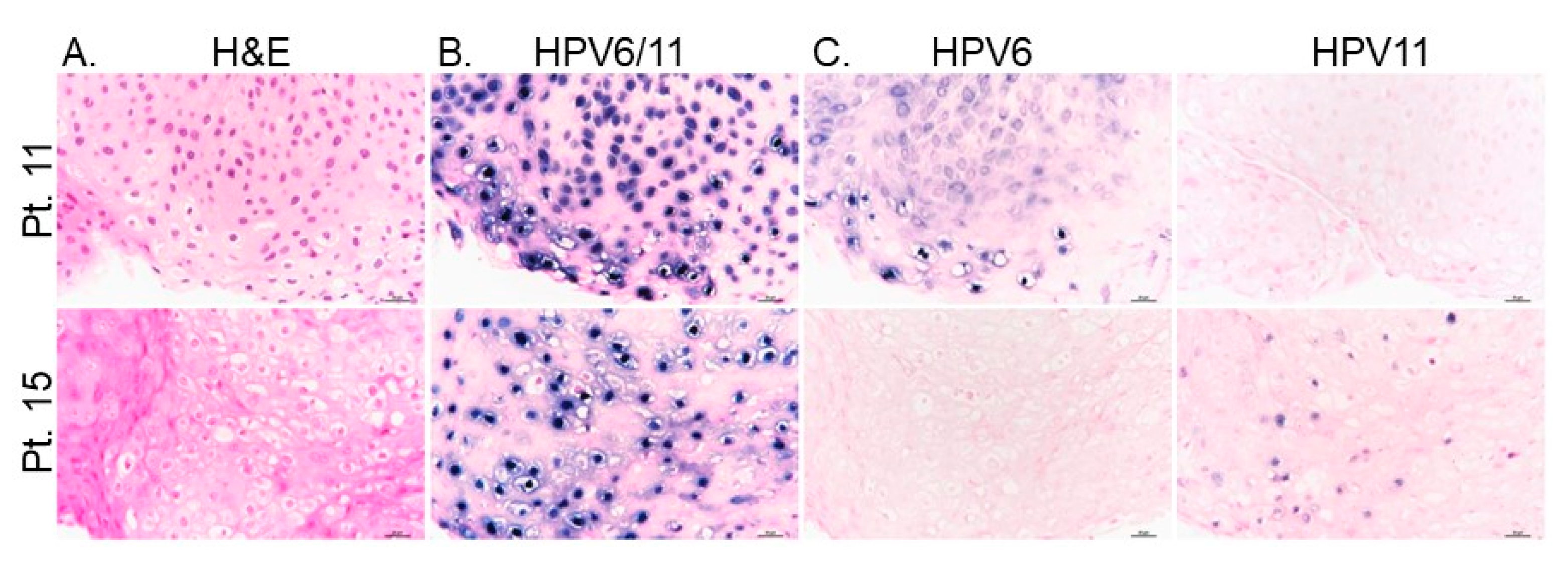 papillomatosis b nh