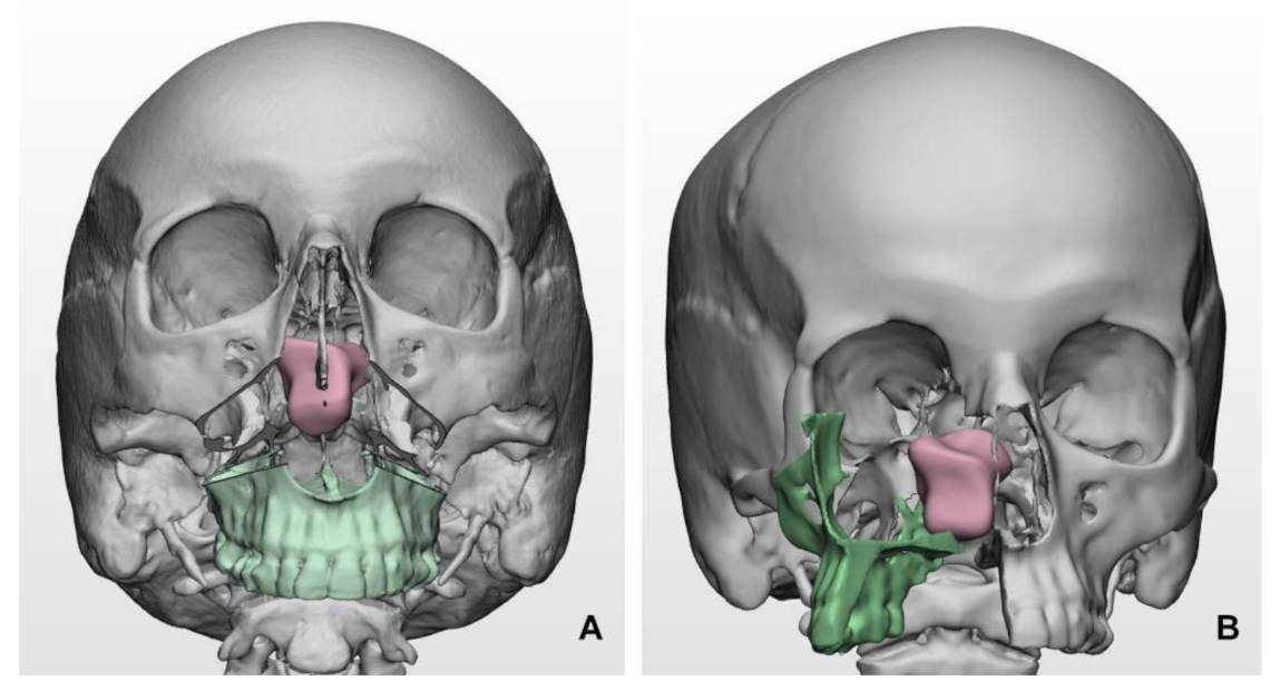 Amazon.co.jp: surgery of skull base tumors (Churchill