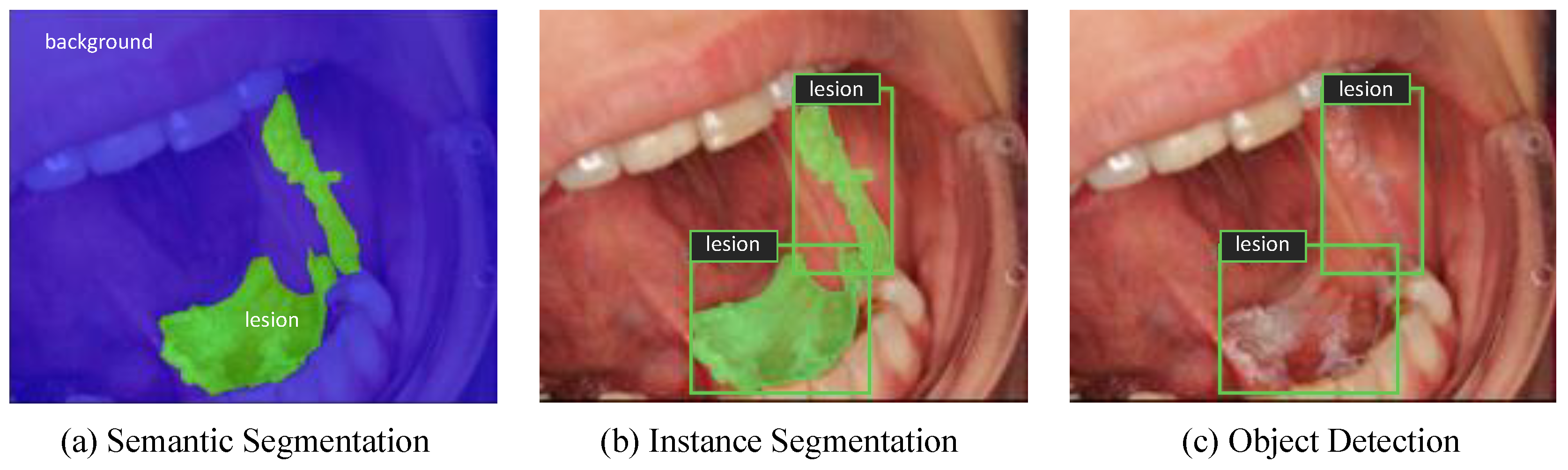Cancers | Free Full-Text | Automated Detection and Classification of Oral  Lesions Using Deep Learning to Detect Oral Potentially Malignant Disorders