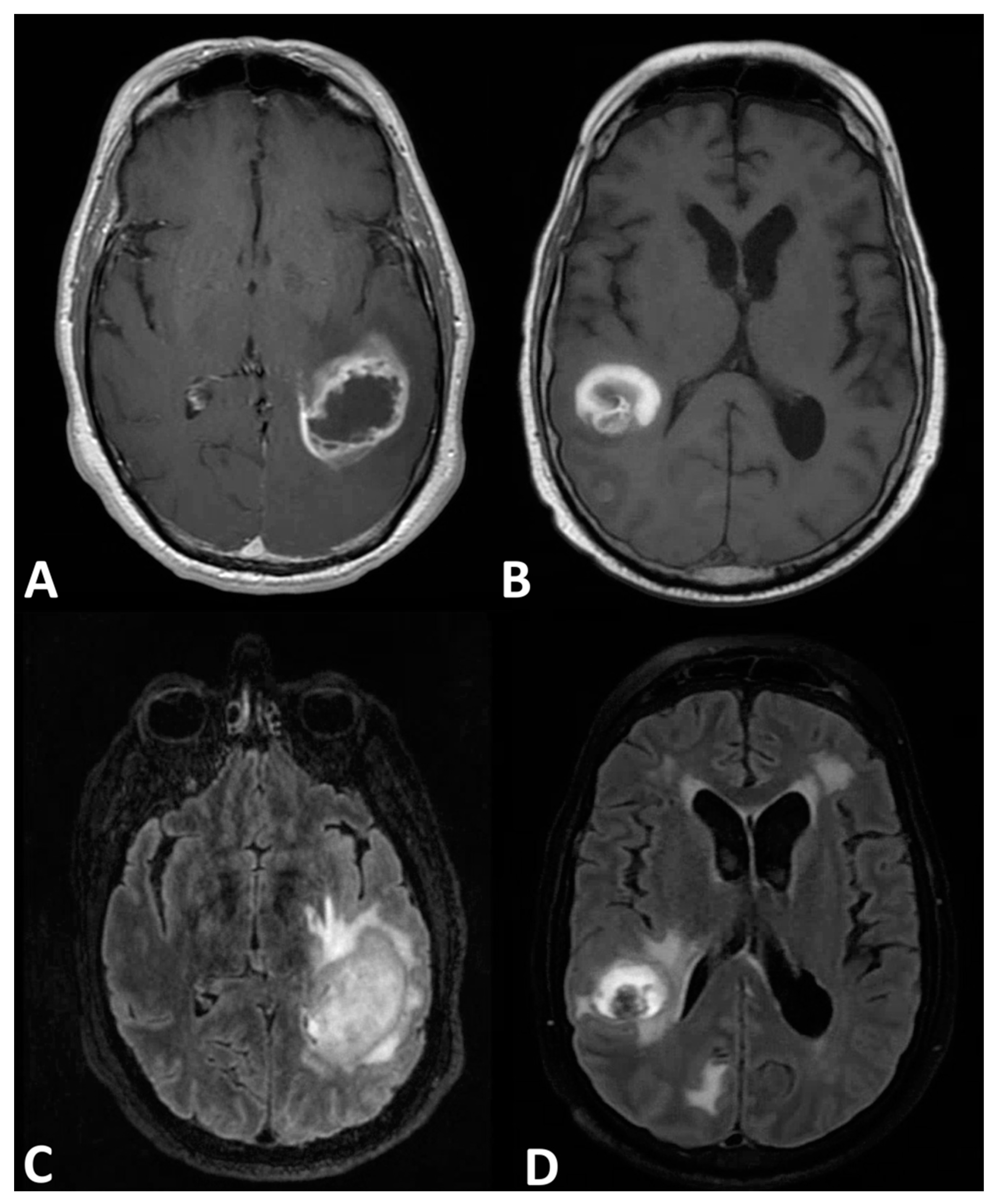 Lord of the rings: MRI with its advances in evaluation of ring enhancing  lesions | Semantic Scholar