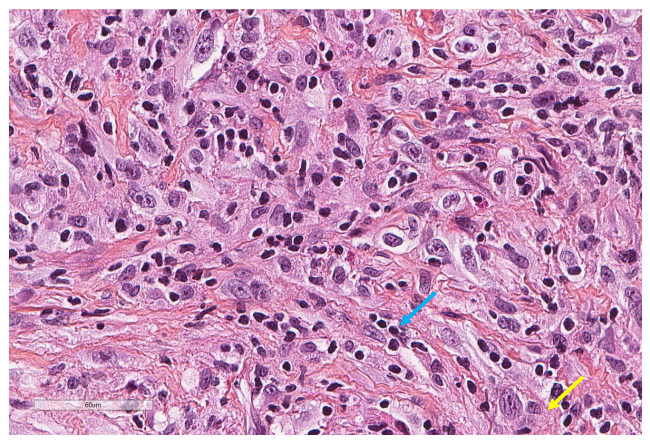 mesothelioma adwords