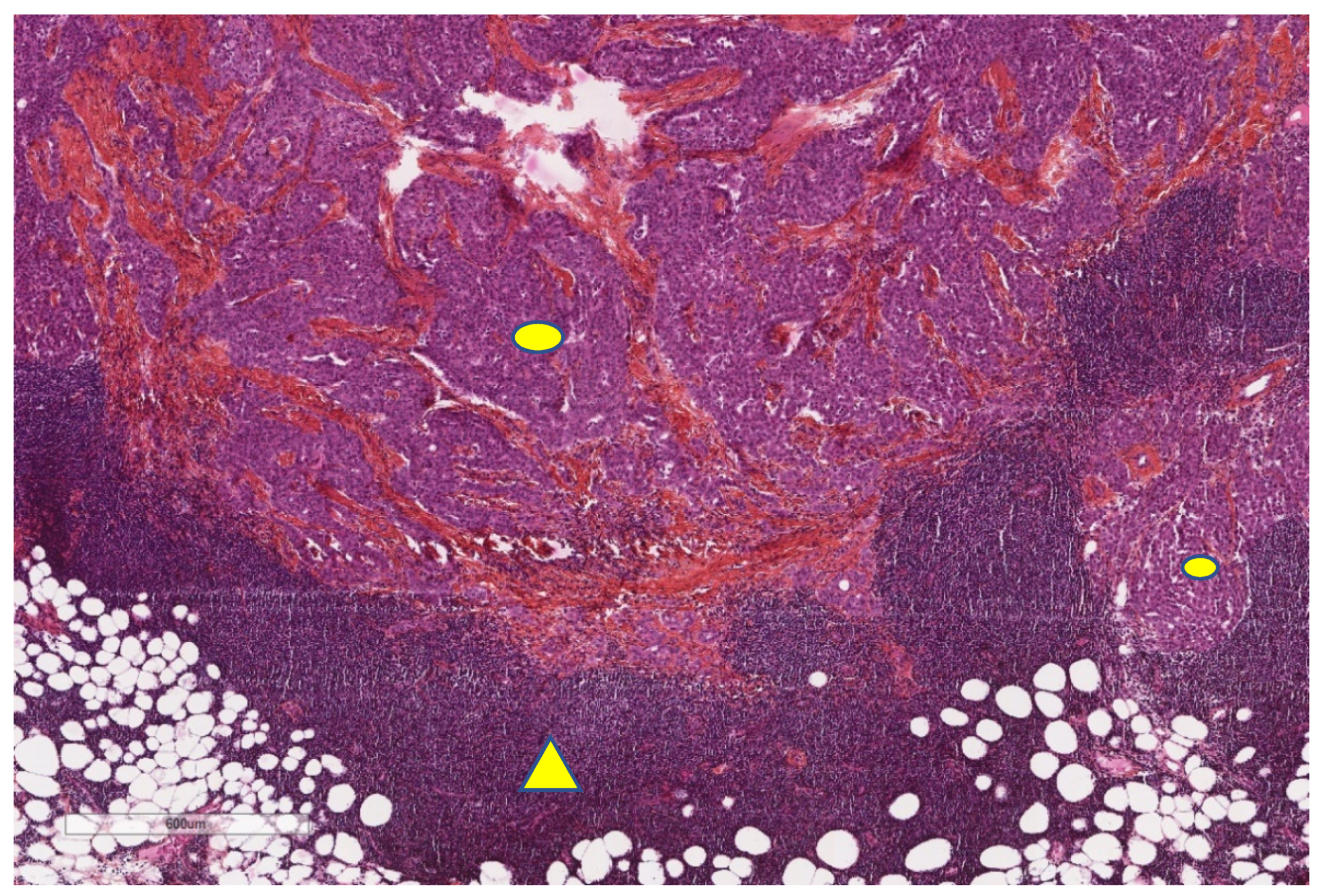 what color represents gallbladder cancer