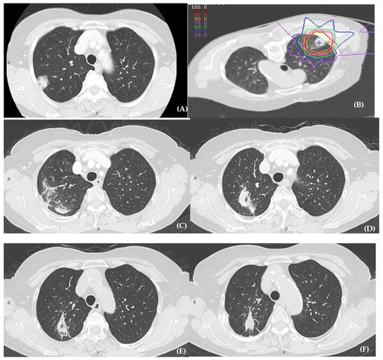 Cancers Free FullText The Risk Factors for Radiation Pneumonitis