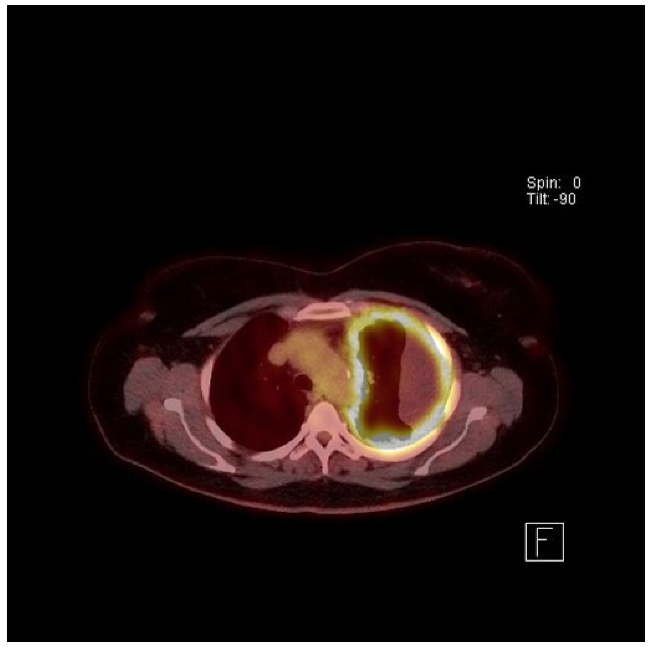 malignant pleural effusion review