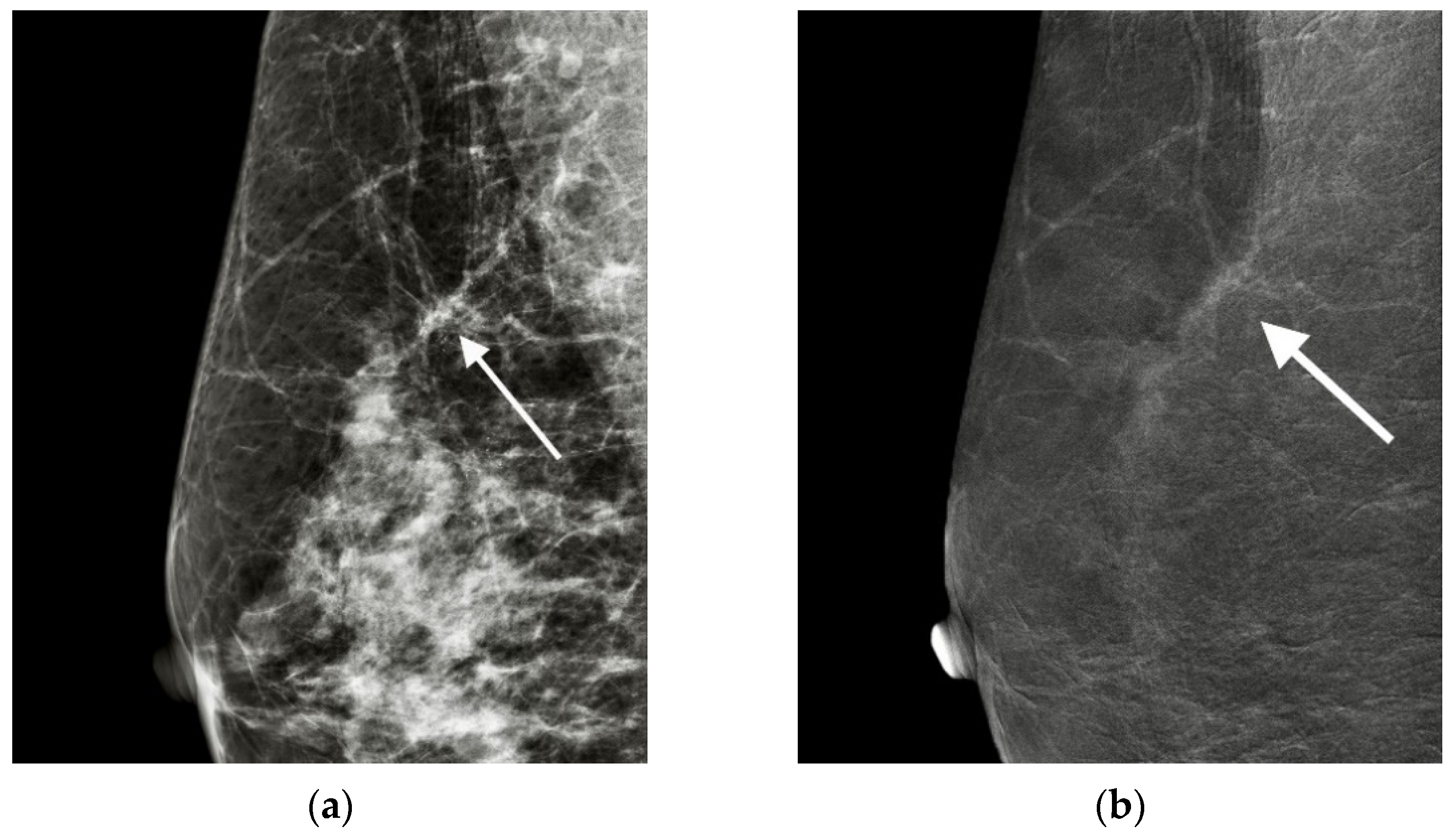 Invasive Ductal Carcinoma Mammogram invasive-ductal-carcinoma-mammogram