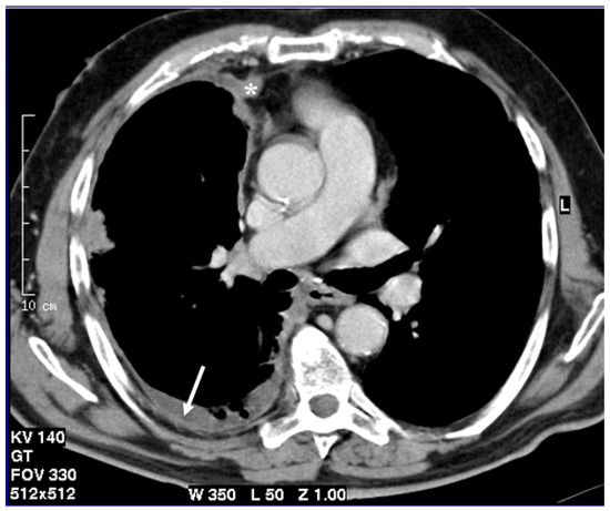 do you need a biopsy to diagnose liver cancer