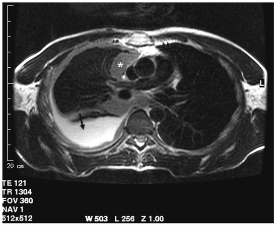 mesothelioma signs and symptoms