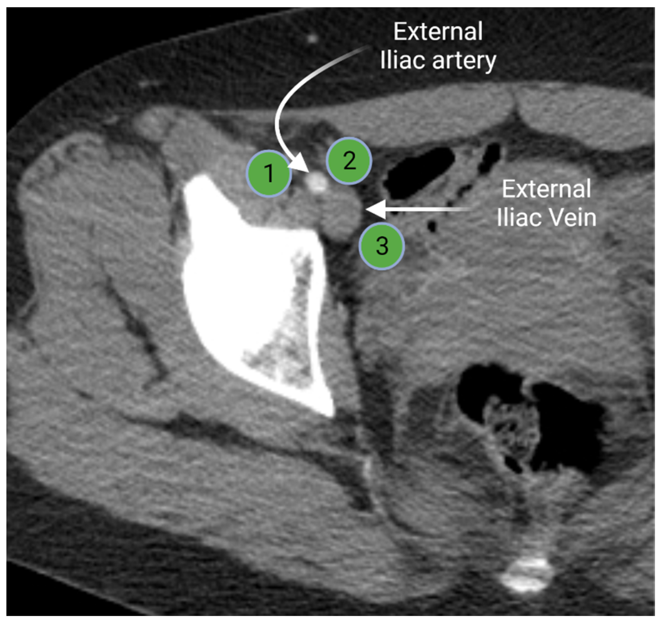 External Iliac Node