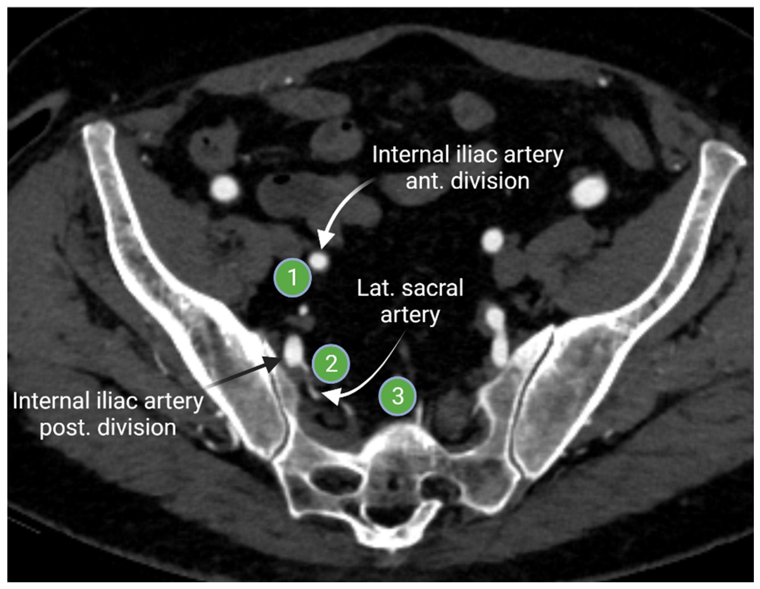 Internal Iliac Lymph Nodes