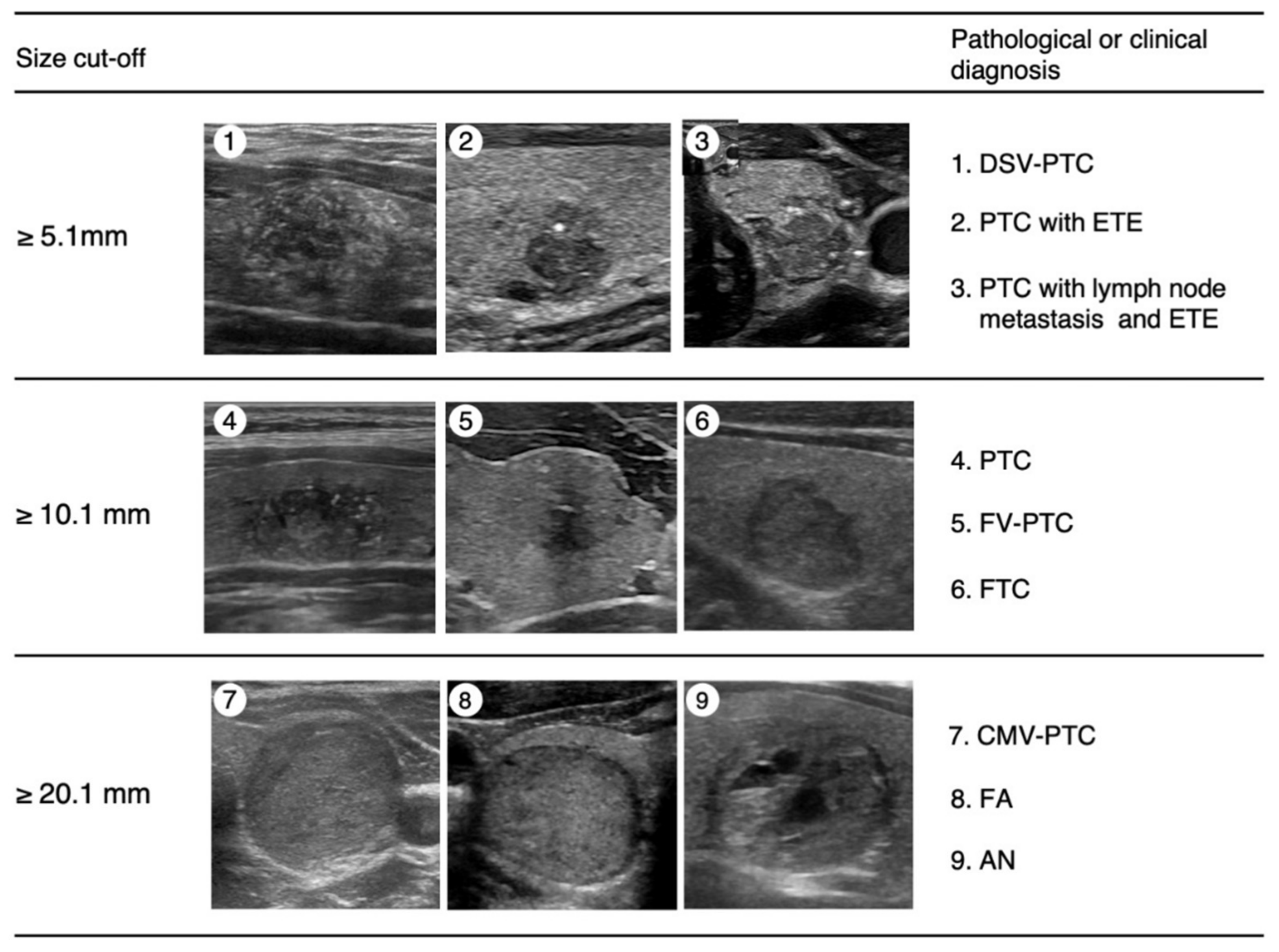 Thyroid Adenoma Ultrasound Appearance anaplastic-thyroid-carcinoma-pathophysiology-treatment