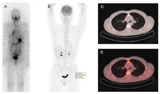 AI in Thyroid Cancer Diagnosis: Techniques, Trends, and