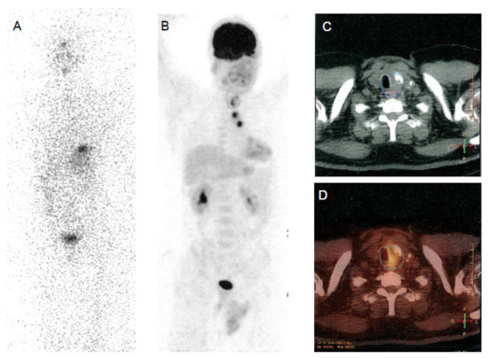Thyroid Cancer Explore vol.3 no.2(2201 「Thyroid Cancer Expl
