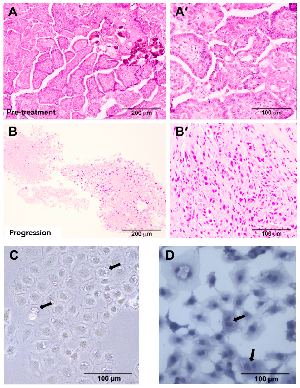 Cancers Free Full Text Rac1 Alterations Induce Acquired Dabrafenib Resistance In Association With Anaplastic Transformation In A Papillary Thyroid Cancer Patient