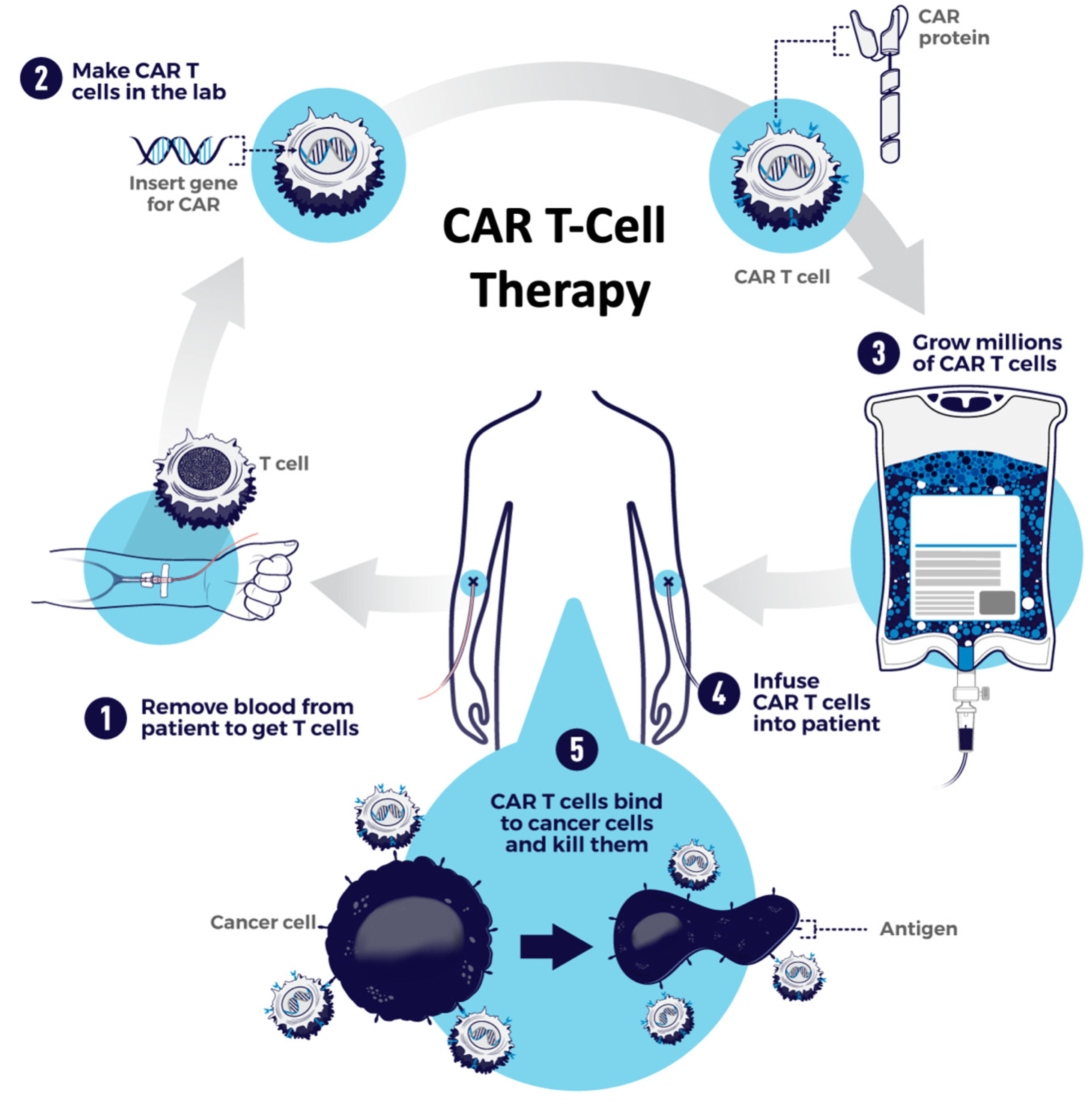 CAR T Cells: Second-Line Treatment Option for NHL? - NCI