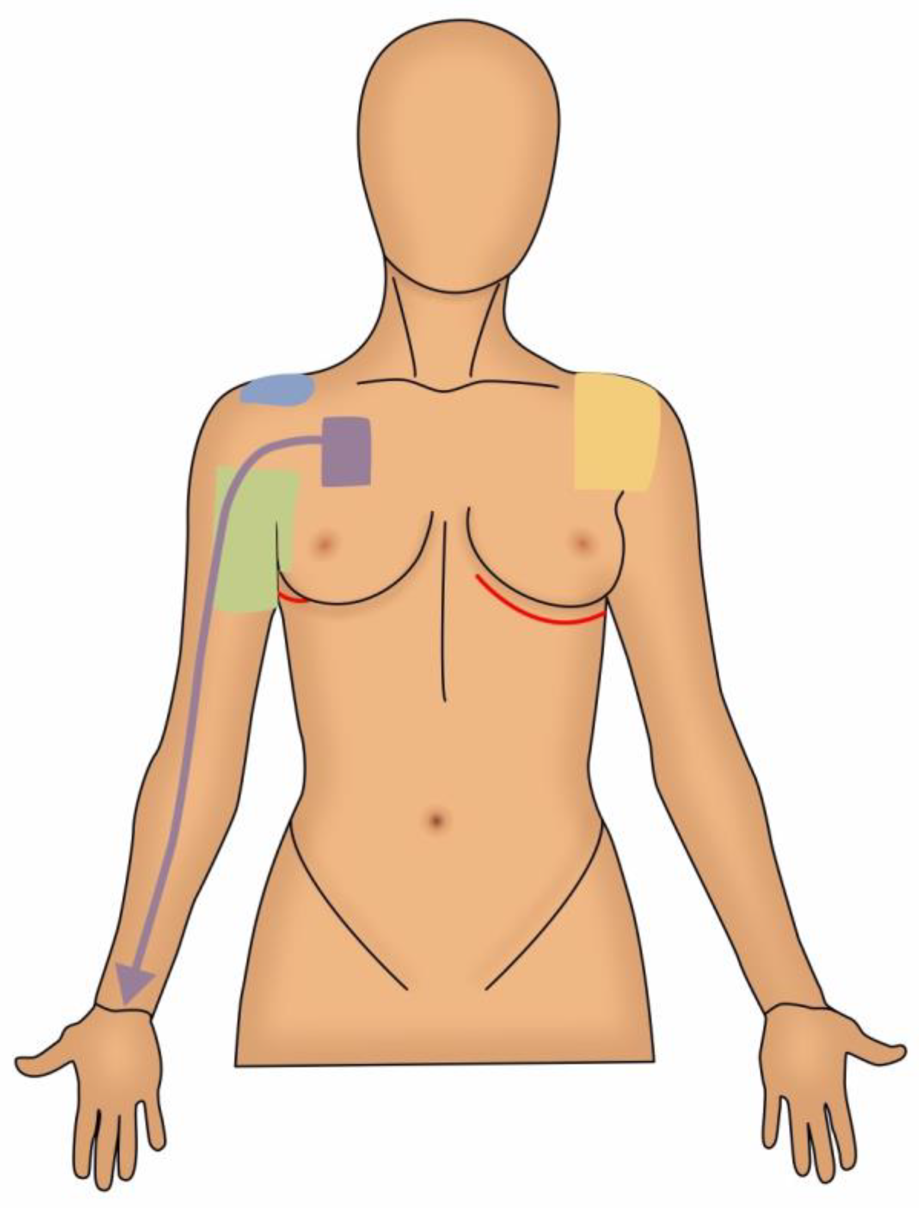 Managing Sharp Stabbing Pain After Breast Reconstruction: Causes and  Solutions