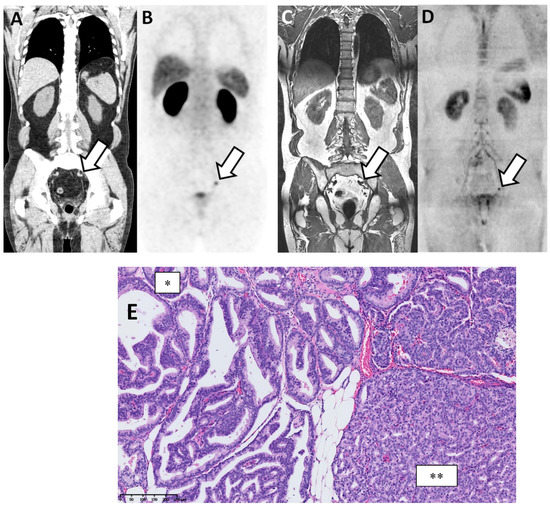 Cancers | Free Full-Text | Comparison of 68Ga-Prostate Specific ...