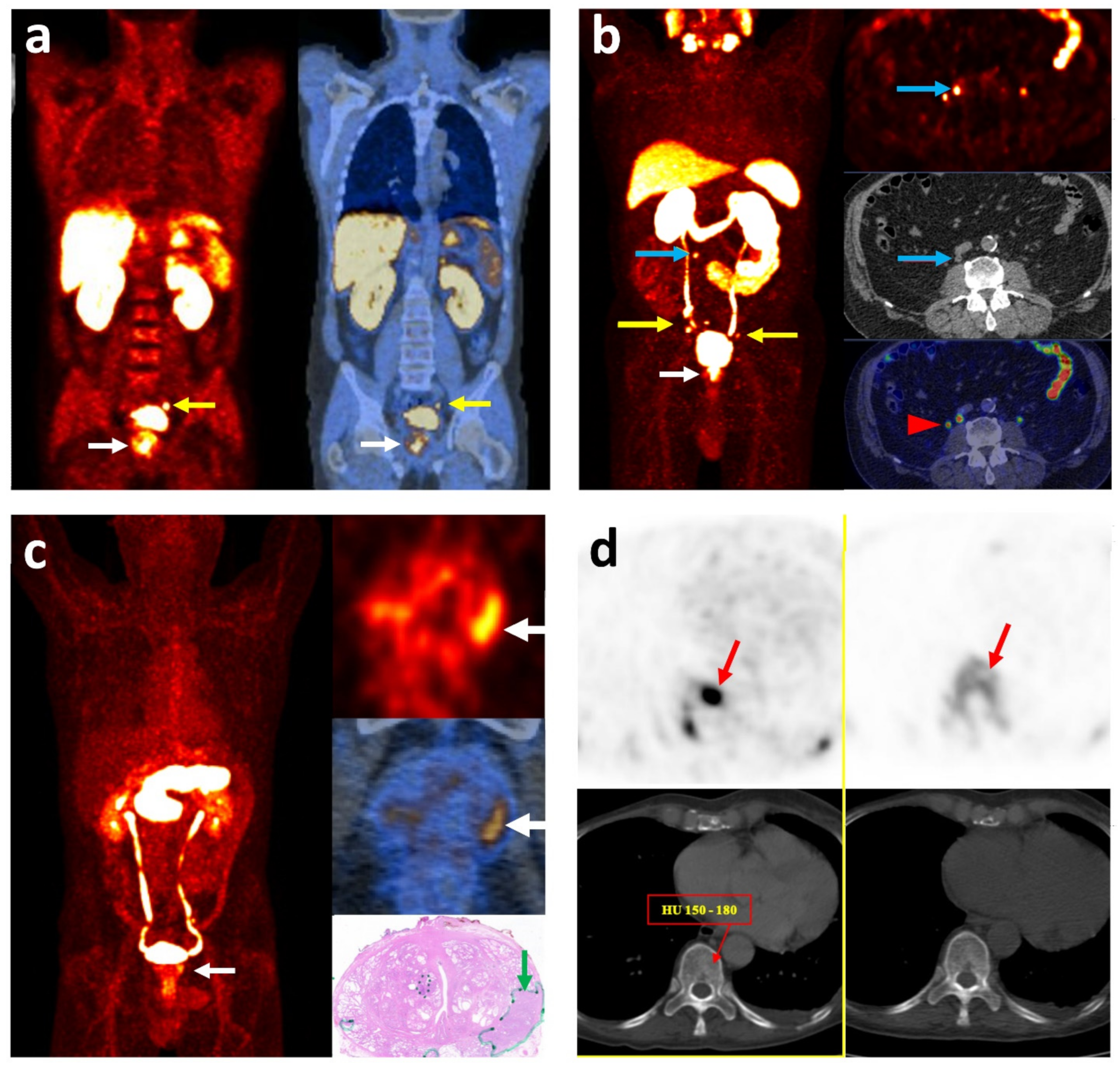 cancer prostate metastase forum