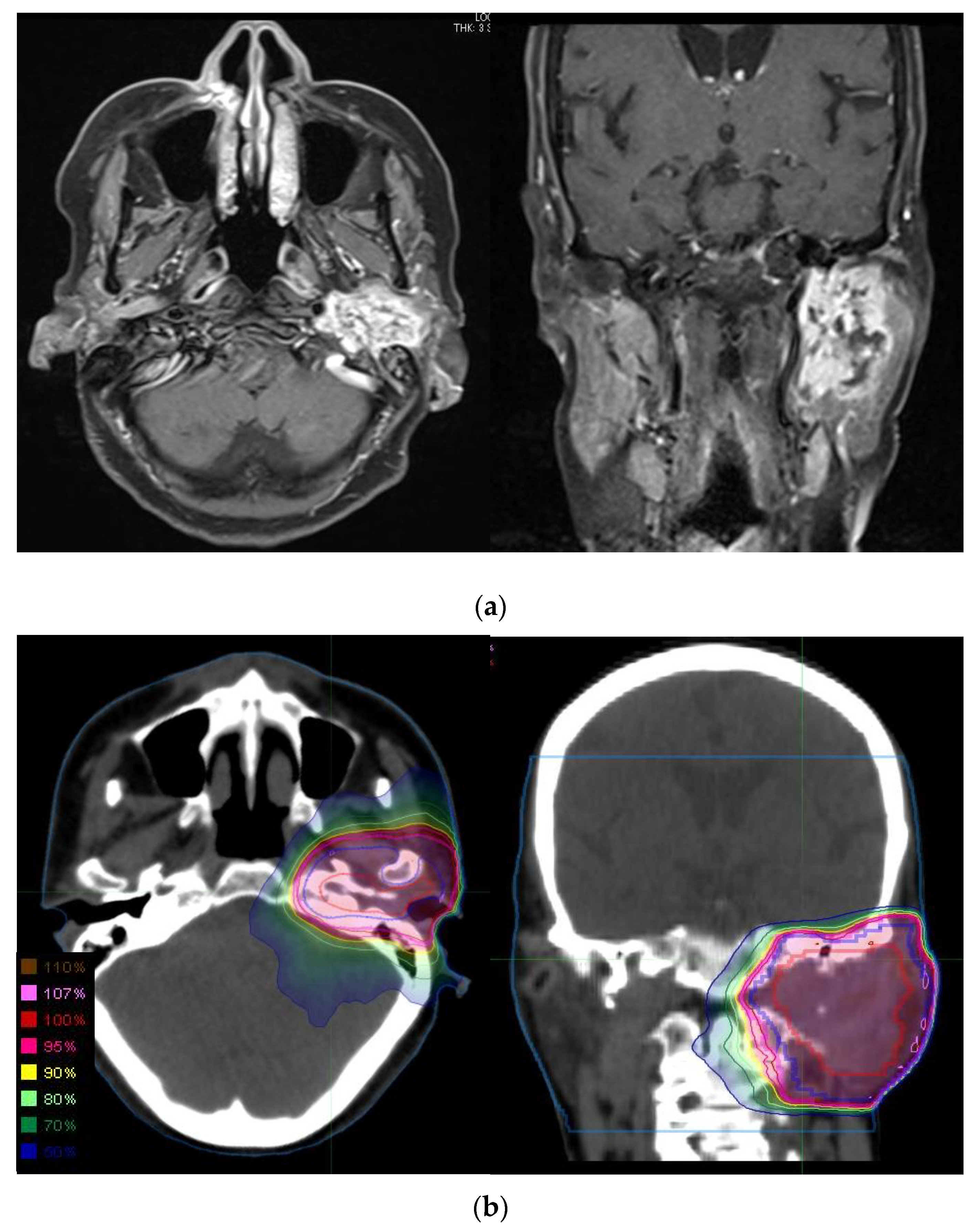 Comparison of Clinical Outcomes of Definitive and Postoperative 
