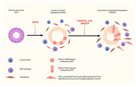 cancers free full text epithelial to mesenchymal transition key regulator of pancreatic ductal adenocarcinoma progression and chemoresistance html