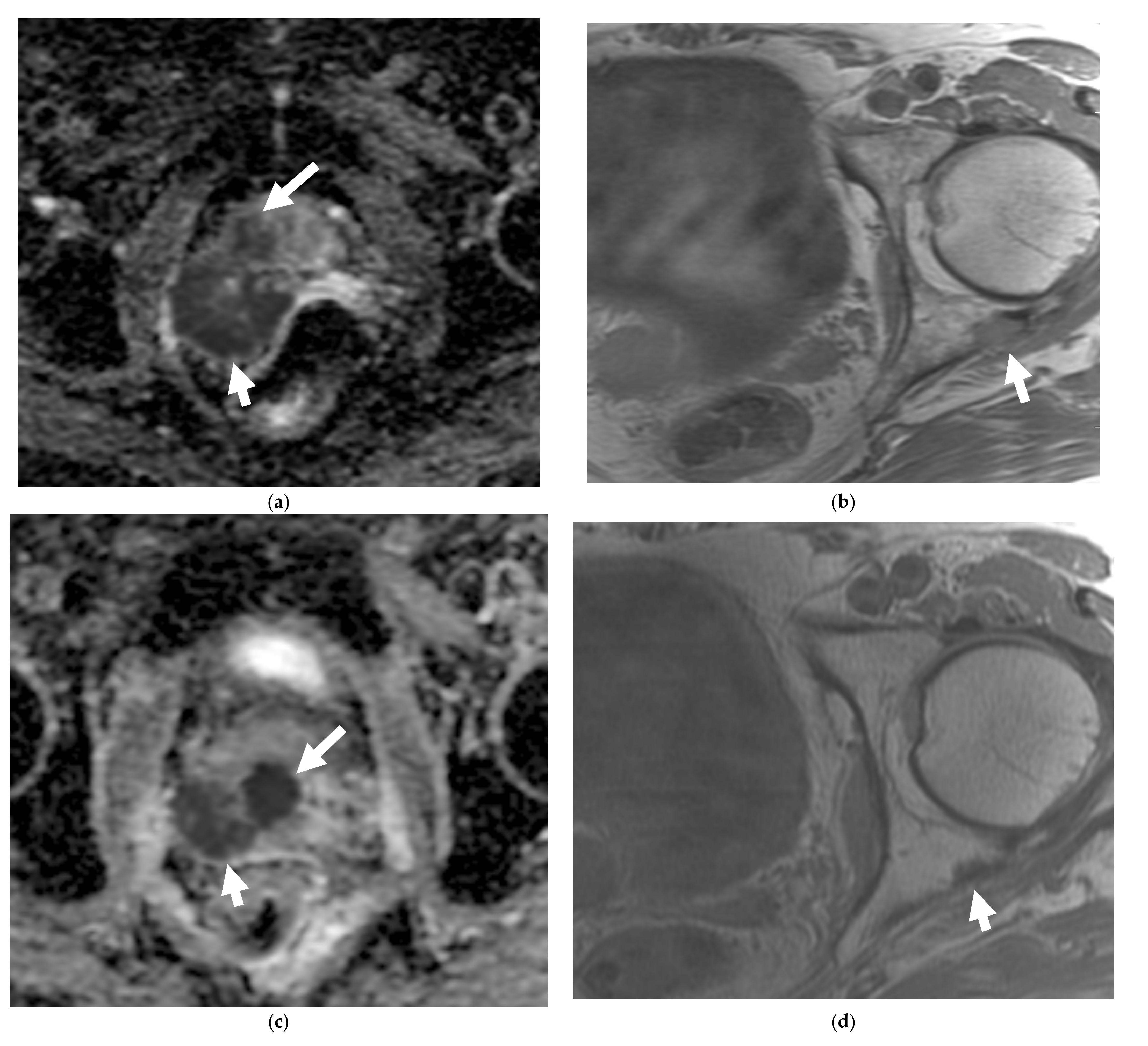 prostatitis és spin