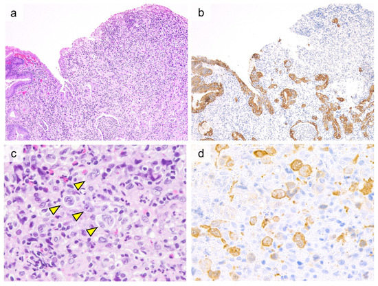 Cancers | Free Full-Text | Primary Gastrointestinal T-Cell 
