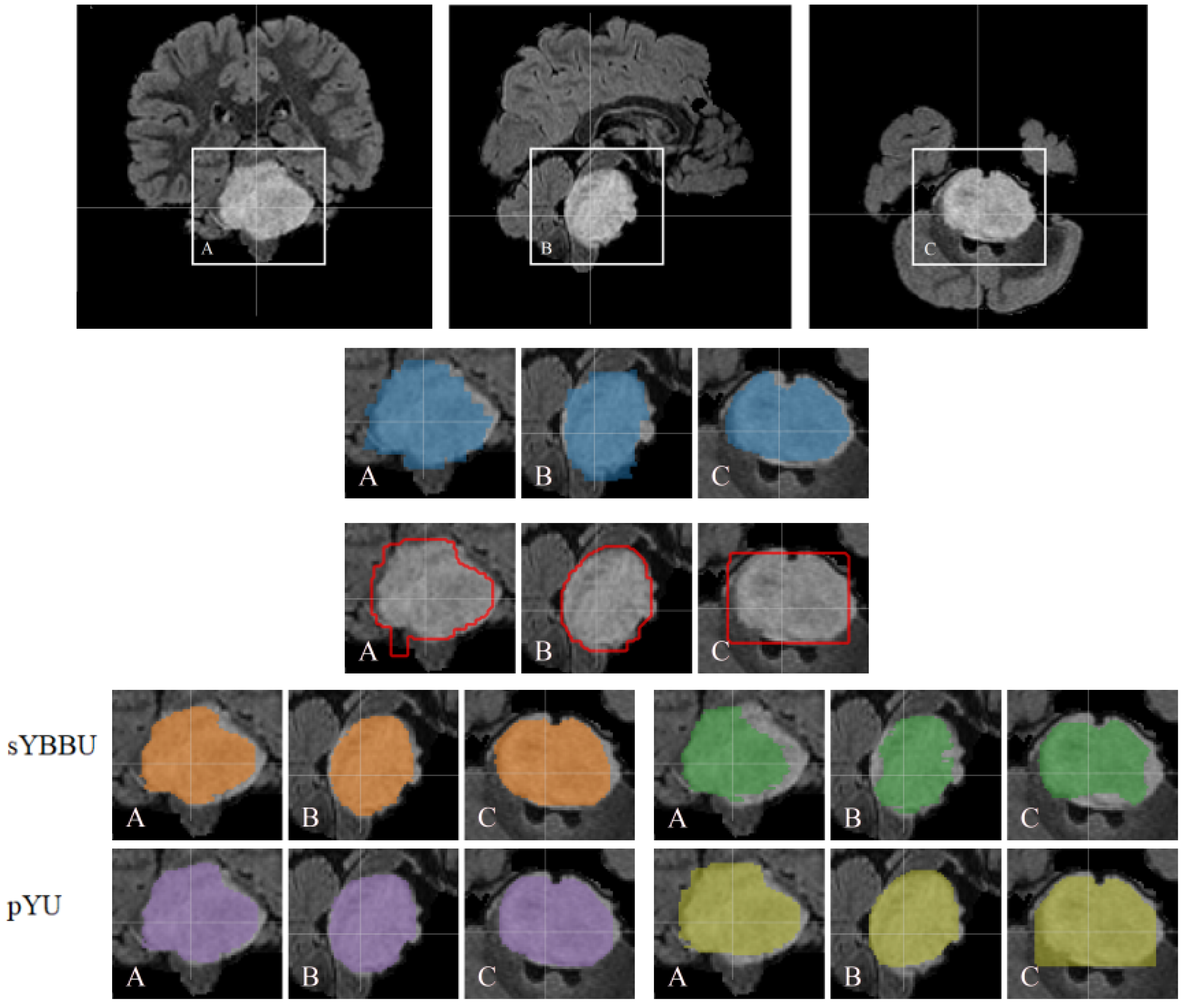 Object Detection Improves Tumour Segmentation in MR Images of Rare ...